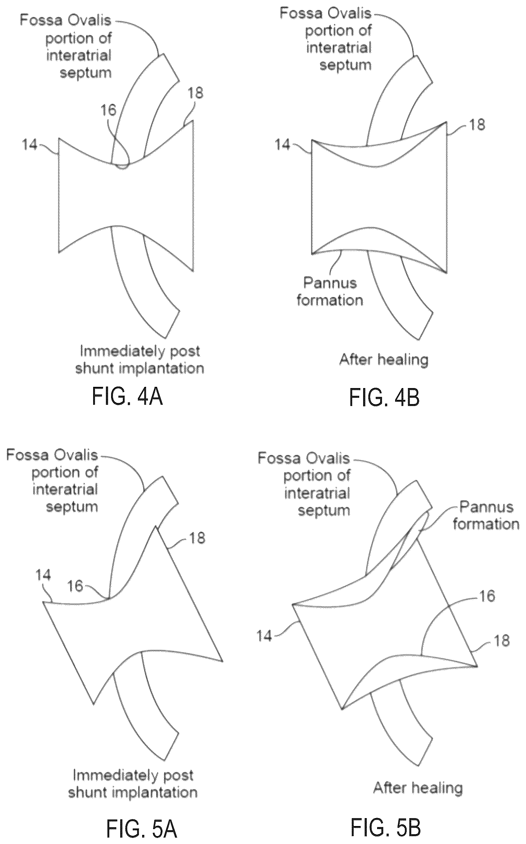 Patent US12311134 Figure 4 – Asymmetric shunt for redistributing atrial blood volume