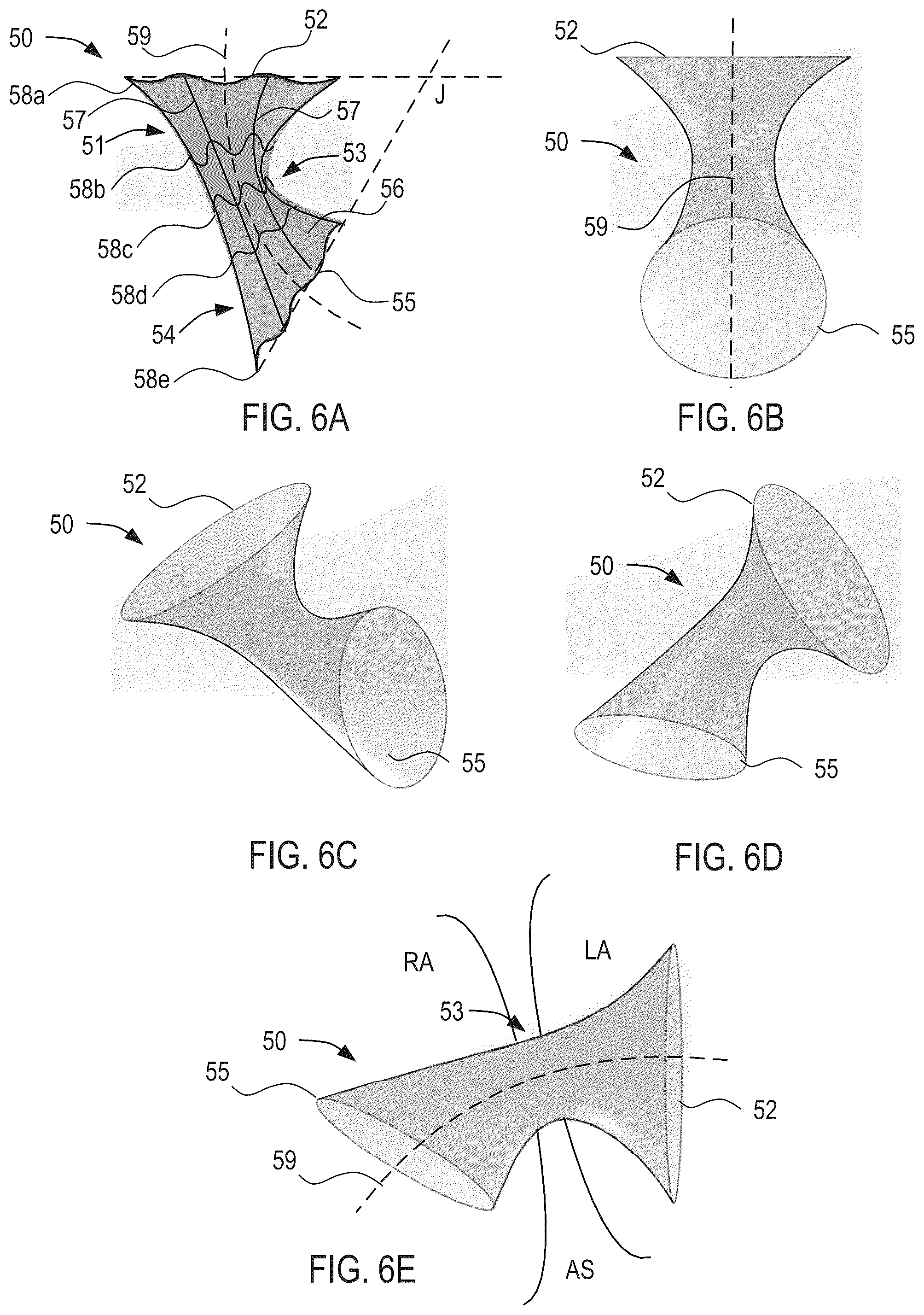 Patent US12311134 Figure 5 – Asymmetric shunt for redistributing atrial blood volume