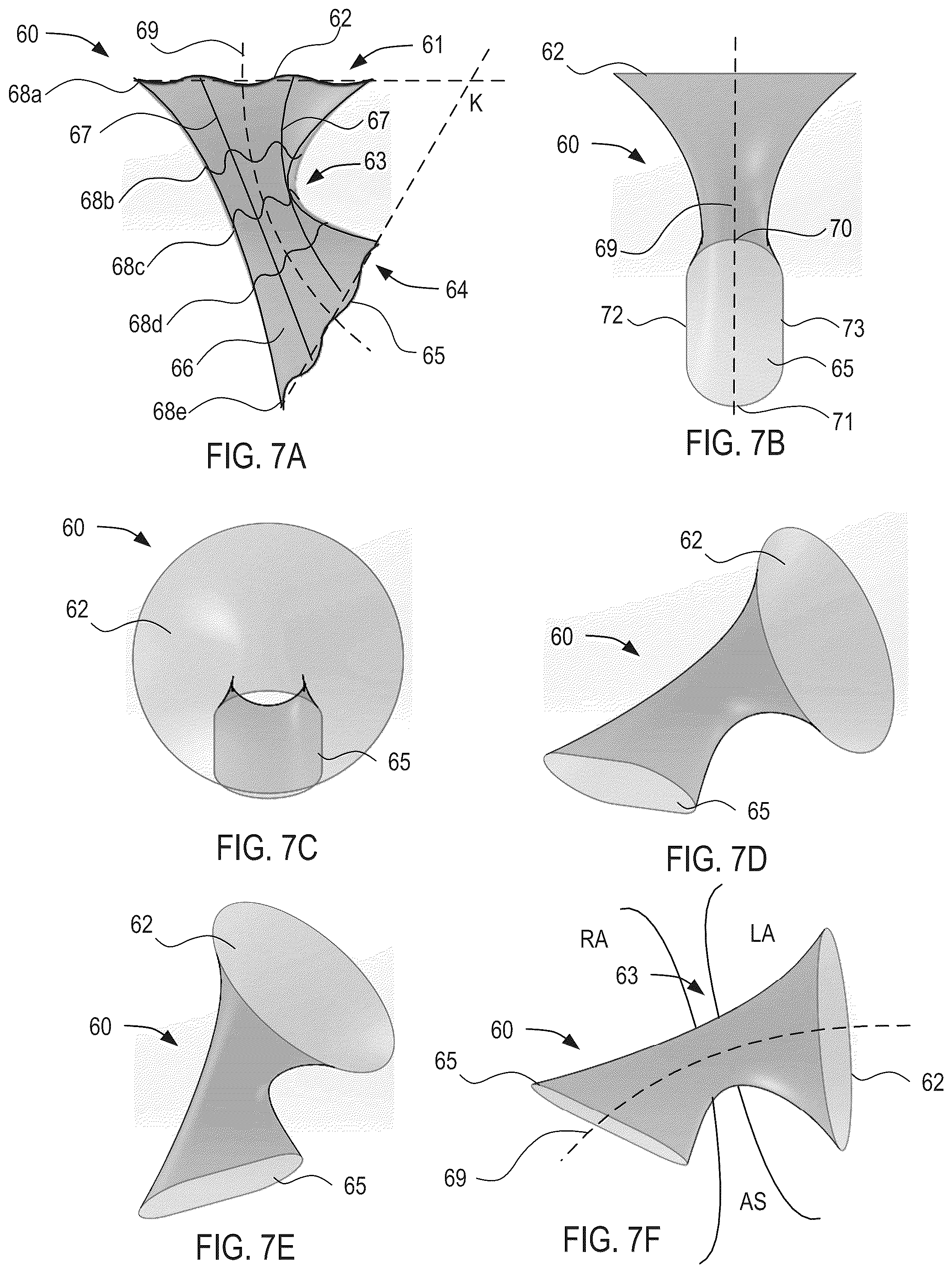 Patent US12311134 Figure 6 – Asymmetric shunt for redistributing atrial blood volume