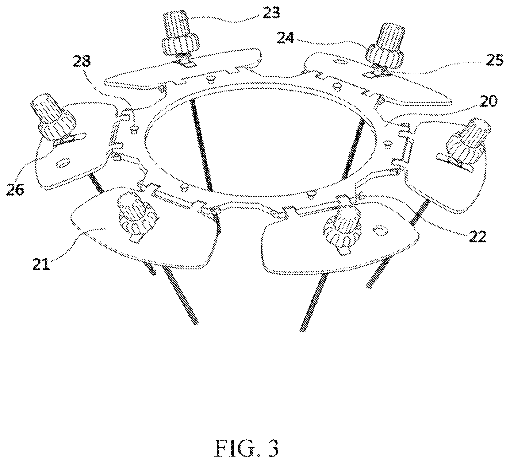 Patent US12311159 Figure 3 – Vacuum assisted sutureless inflow cannula and ring implantation of ventricular assist devices
