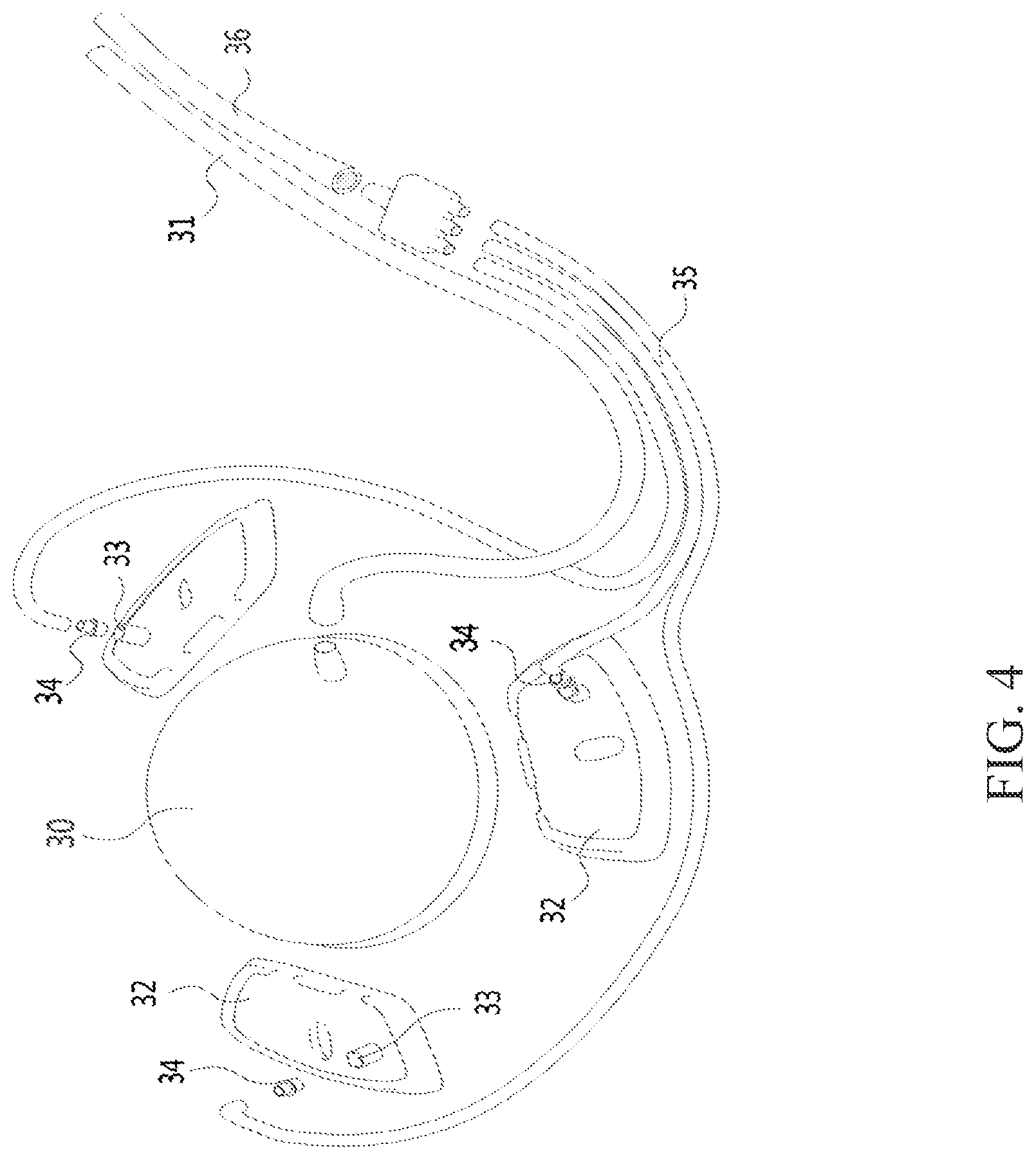 Patent US12311159 Figure 4 – Vacuum assisted sutureless inflow cannula and ring implantation of ventricular assist devices