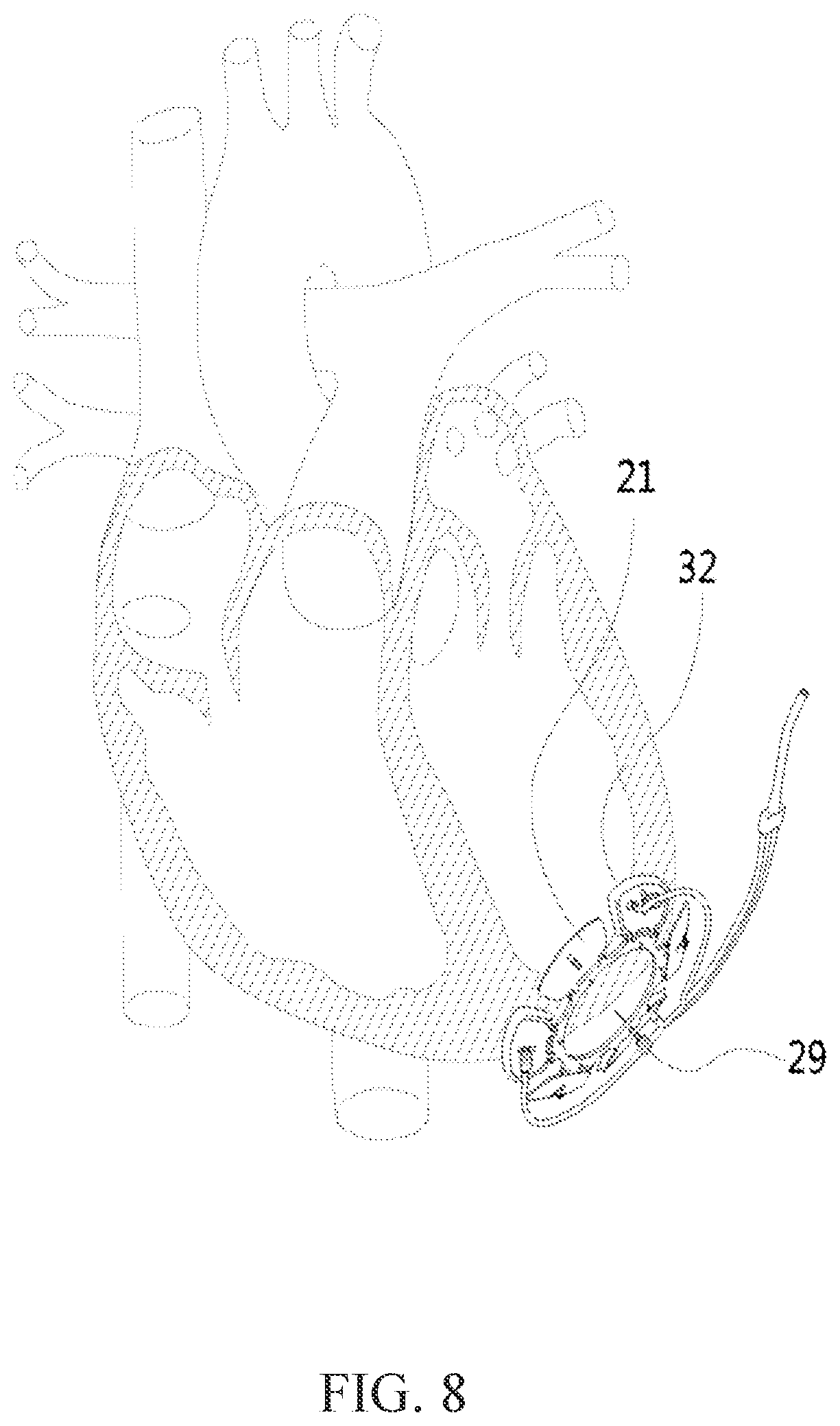 Patent US12311159 Figure 8 – Vacuum assisted sutureless inflow cannula and ring implantation of ventricular assist devices