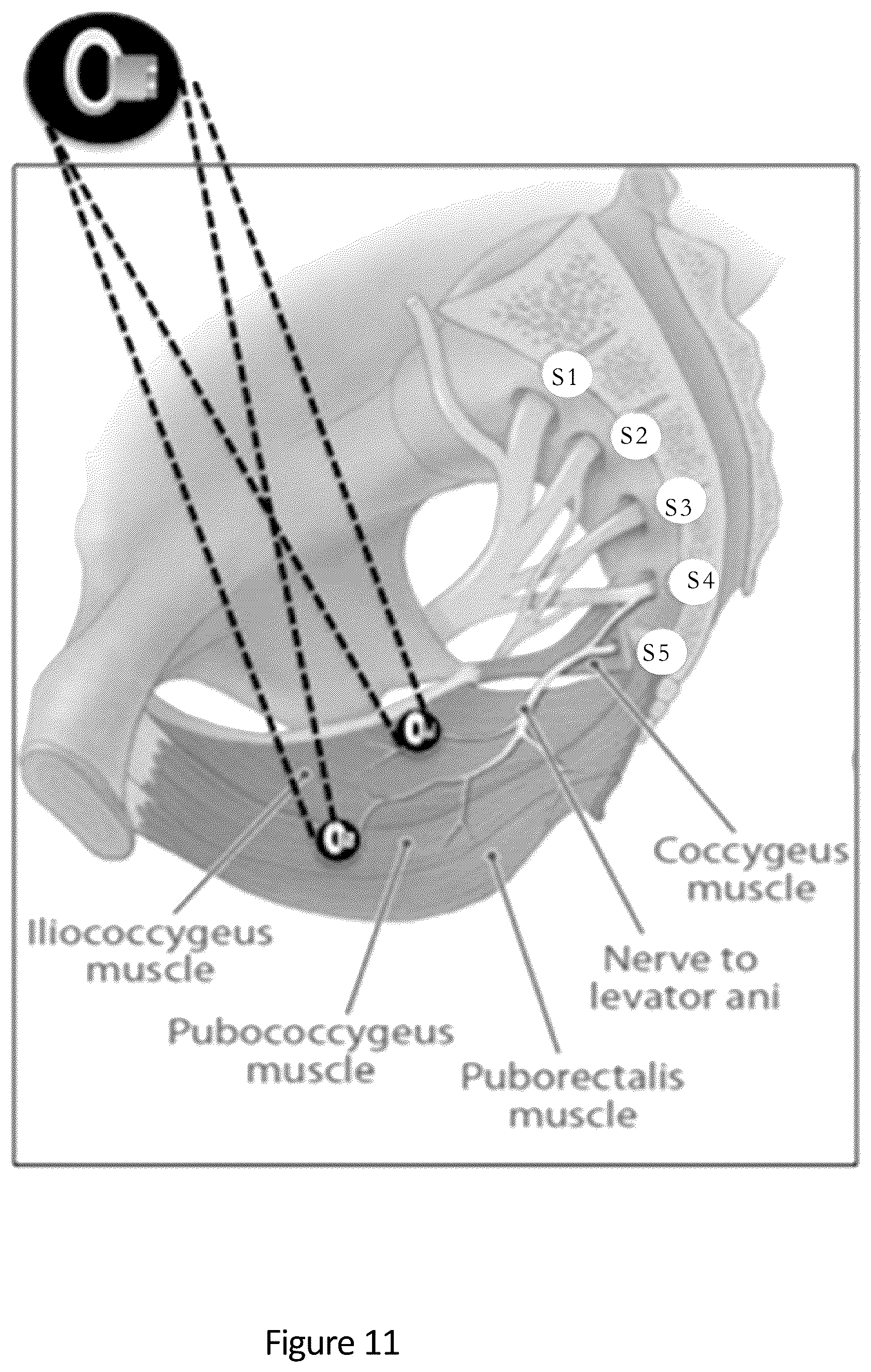 Patent US12311164 Figure 16 – Devices and methods for neuromodulation