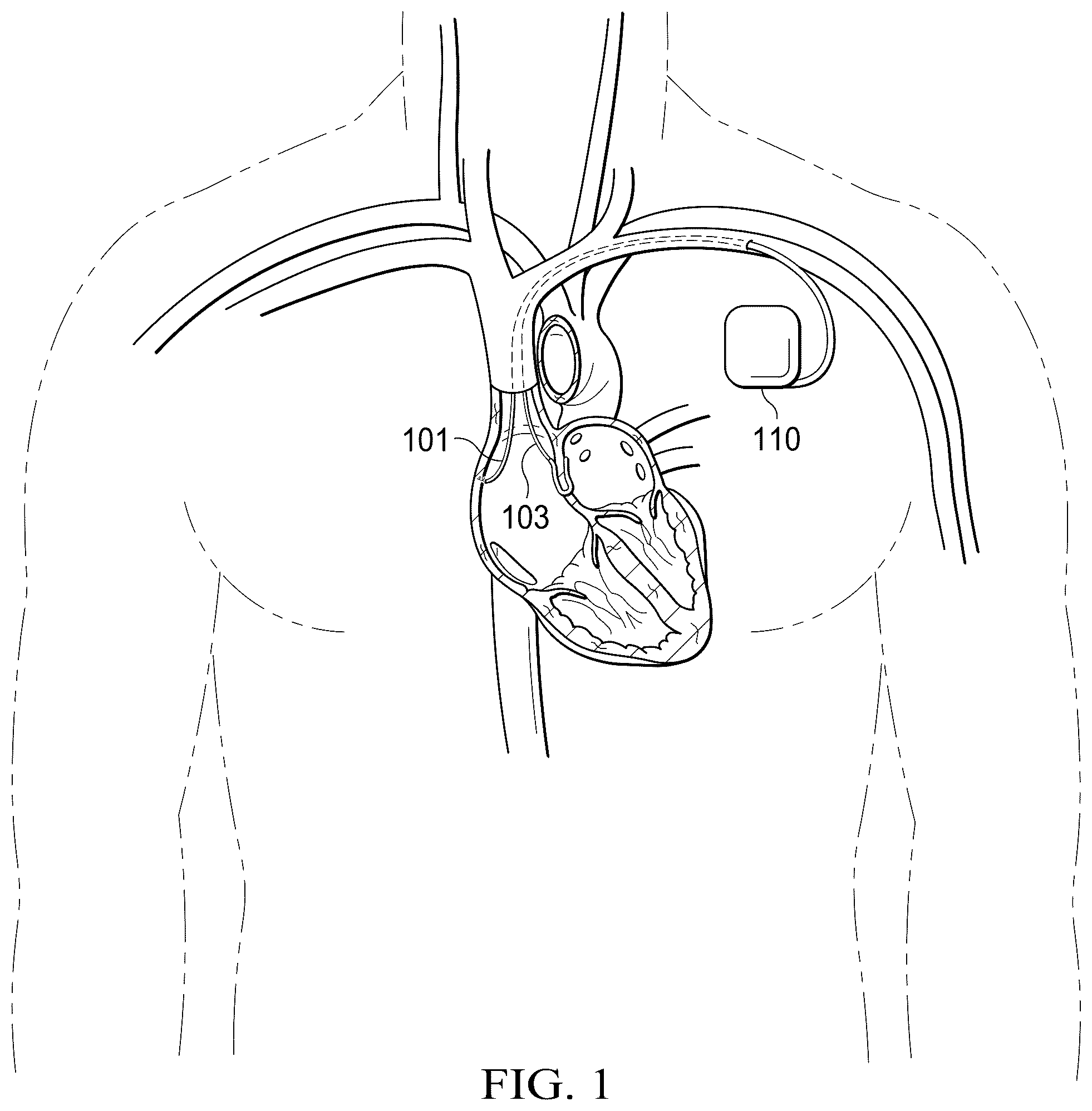 Patent US12311165 Figure 1 – Implantable endovascular, low profile intracardiac left atrial restraining devices for low energy atrial cardioversion, pacing and sensing