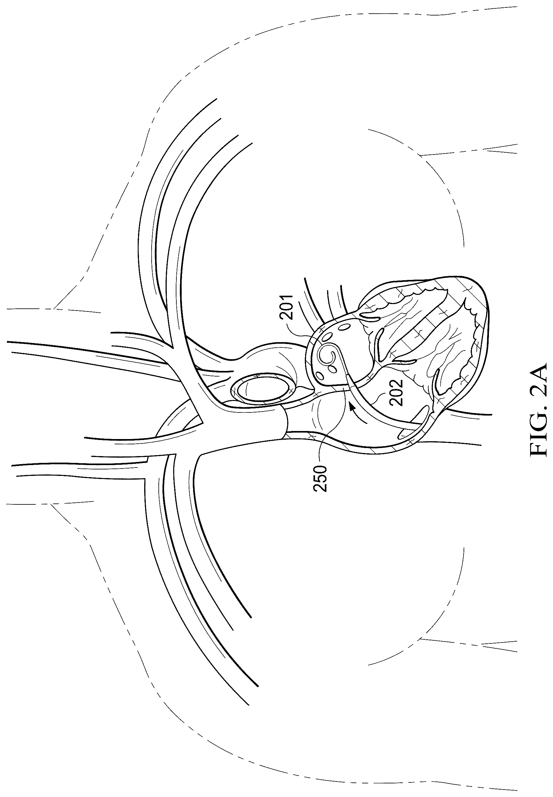 Patent US12311165 Figure 2 – Implantable endovascular, low profile intracardiac left atrial restraining devices for low energy atrial cardioversion, pacing and sensing