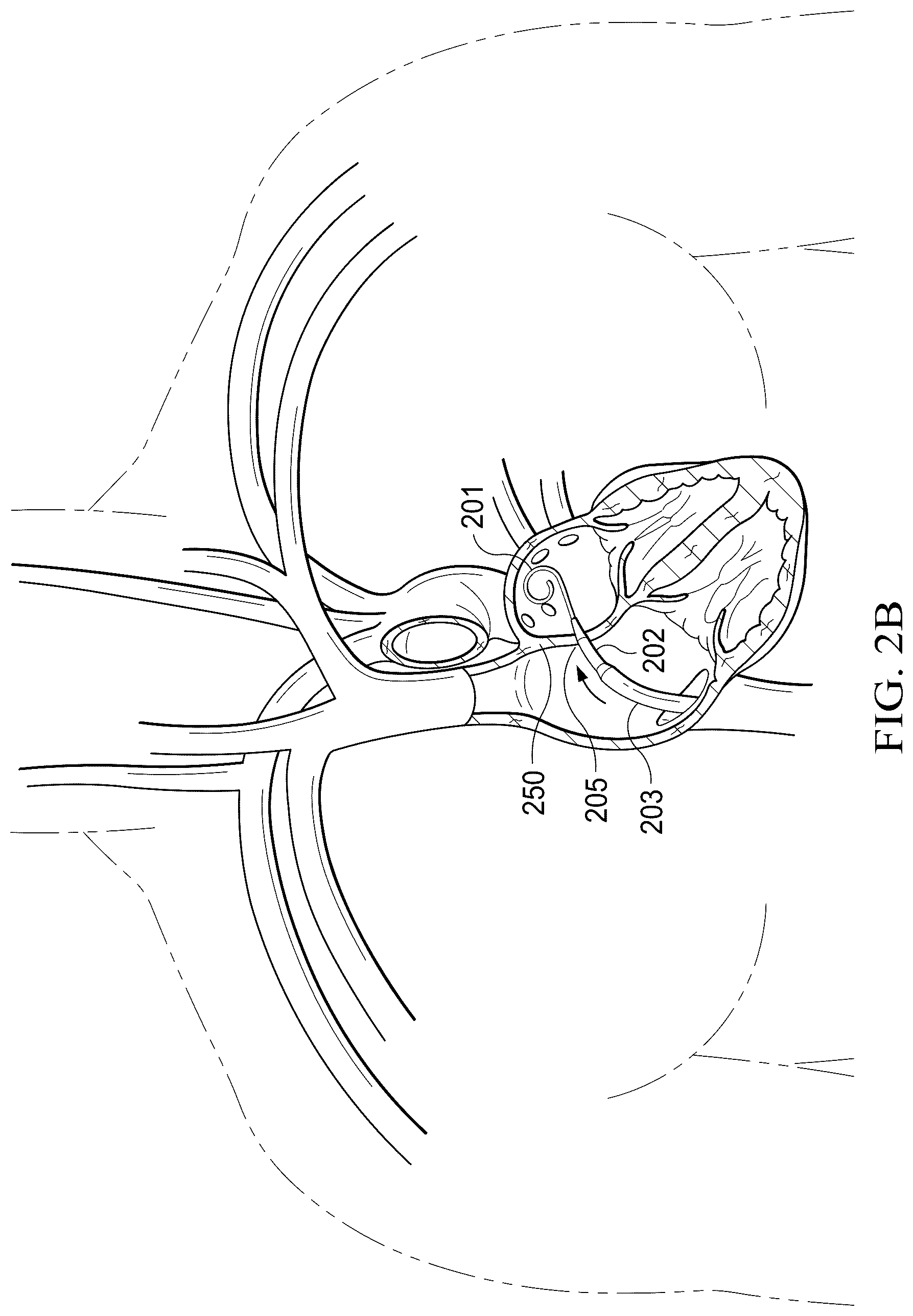 Patent US12311165 Figure 3 – Implantable endovascular, low profile intracardiac left atrial restraining devices for low energy atrial cardioversion, pacing and sensing