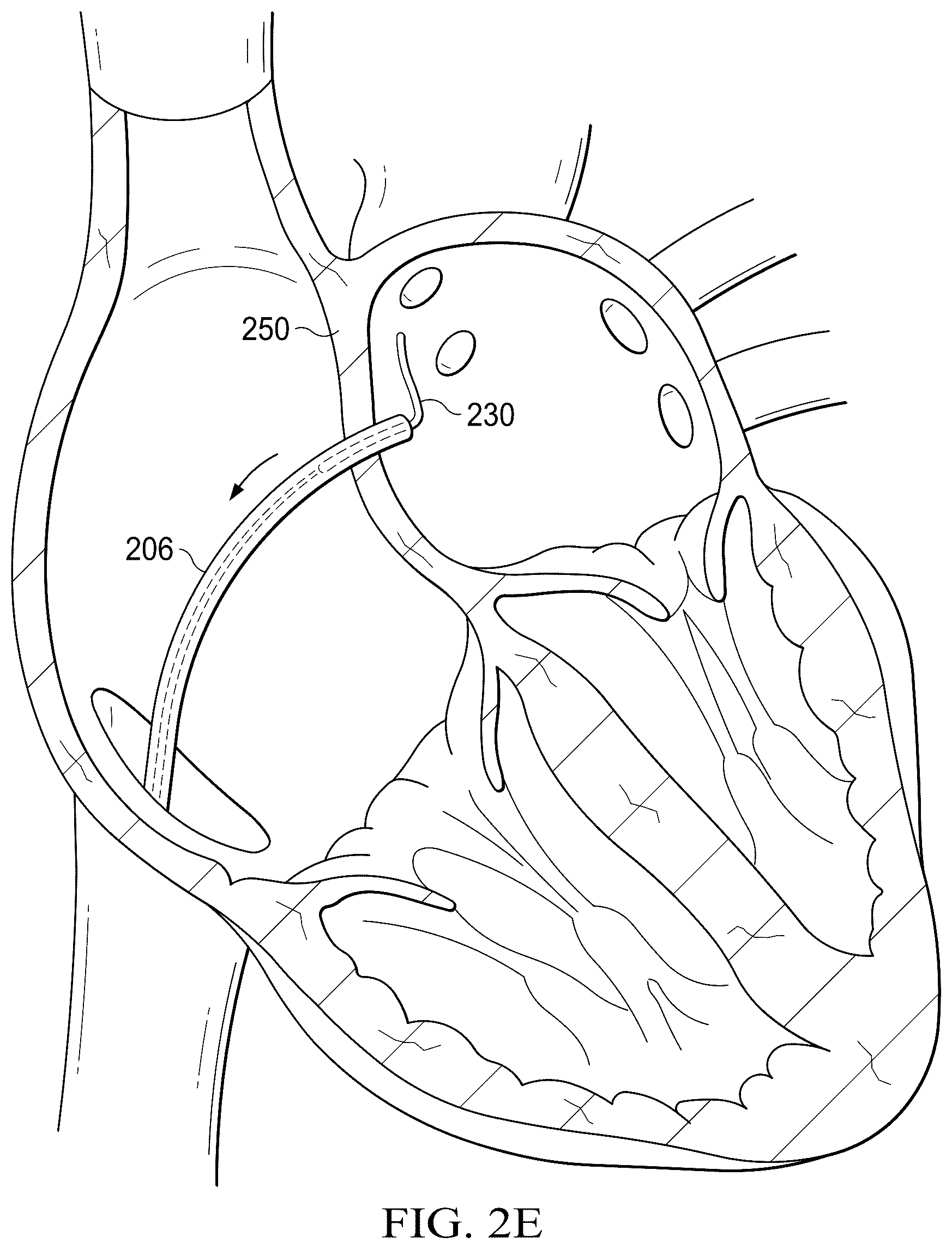 Patent US12311165 Figure 6 – Implantable endovascular, low profile intracardiac left atrial restraining devices for low energy atrial cardioversion, pacing and sensing