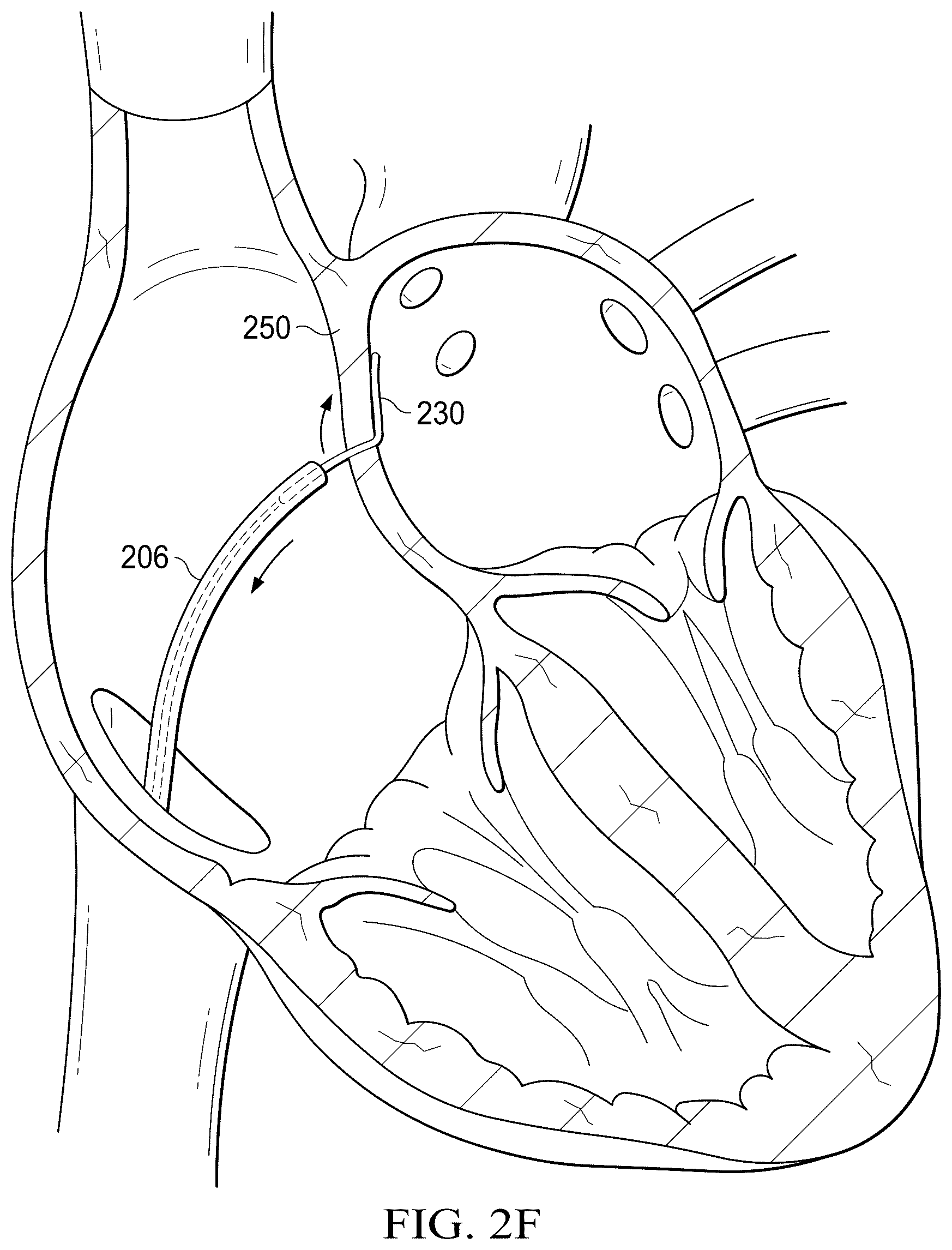 Patent US12311165 Figure 7 – Implantable endovascular, low profile intracardiac left atrial restraining devices for low energy atrial cardioversion, pacing and sensing