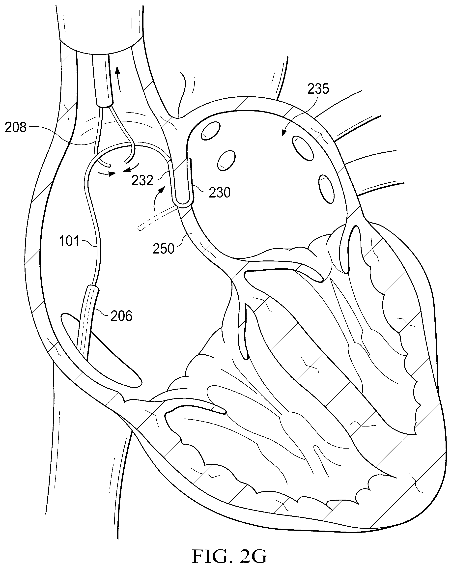 Patent US12311165 Figure 8 – Implantable endovascular, low profile intracardiac left atrial restraining devices for low energy atrial cardioversion, pacing and sensing