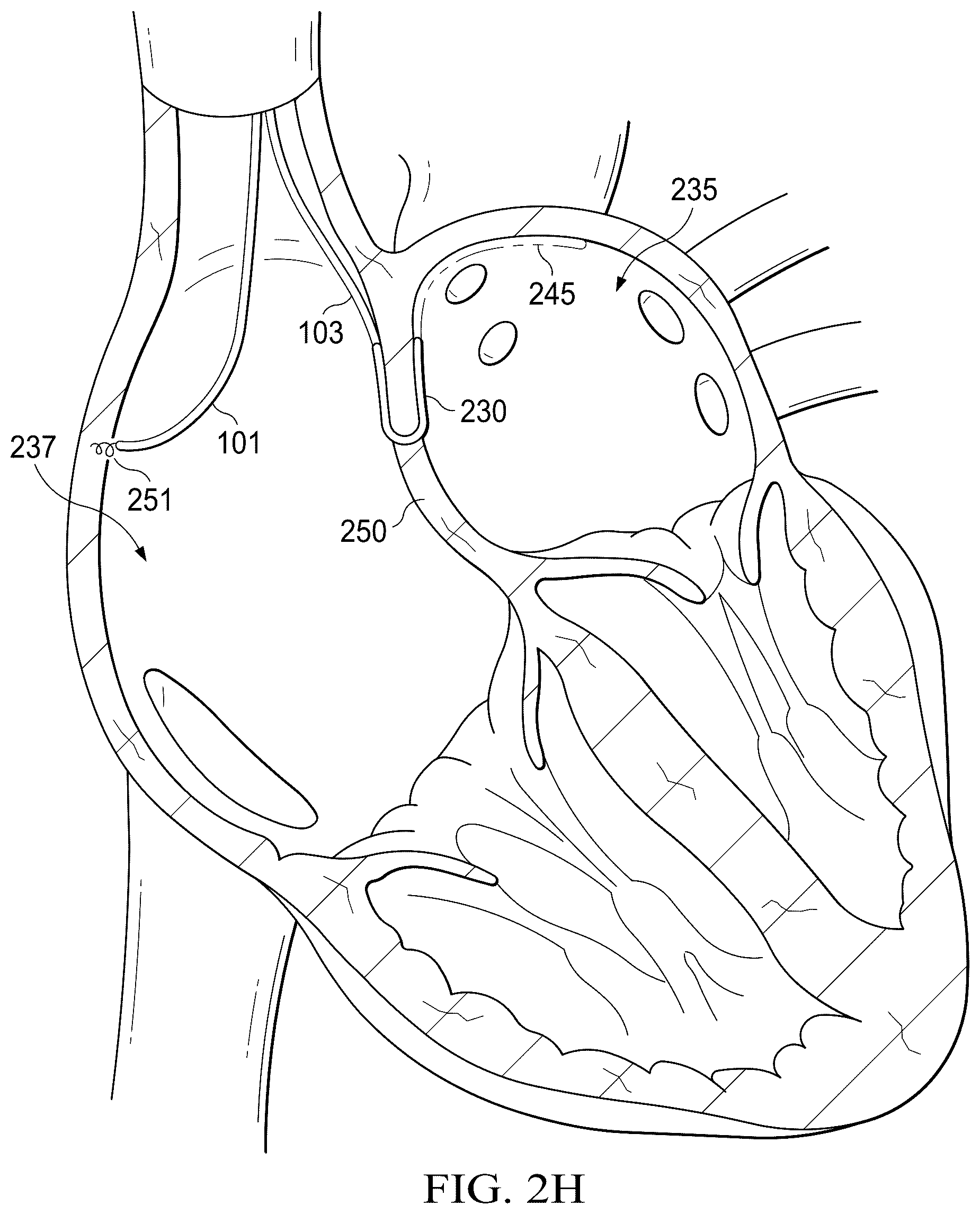 Patent US12311165 Figure 9 – Implantable endovascular, low profile intracardiac left atrial restraining devices for low energy atrial cardioversion, pacing and sensing