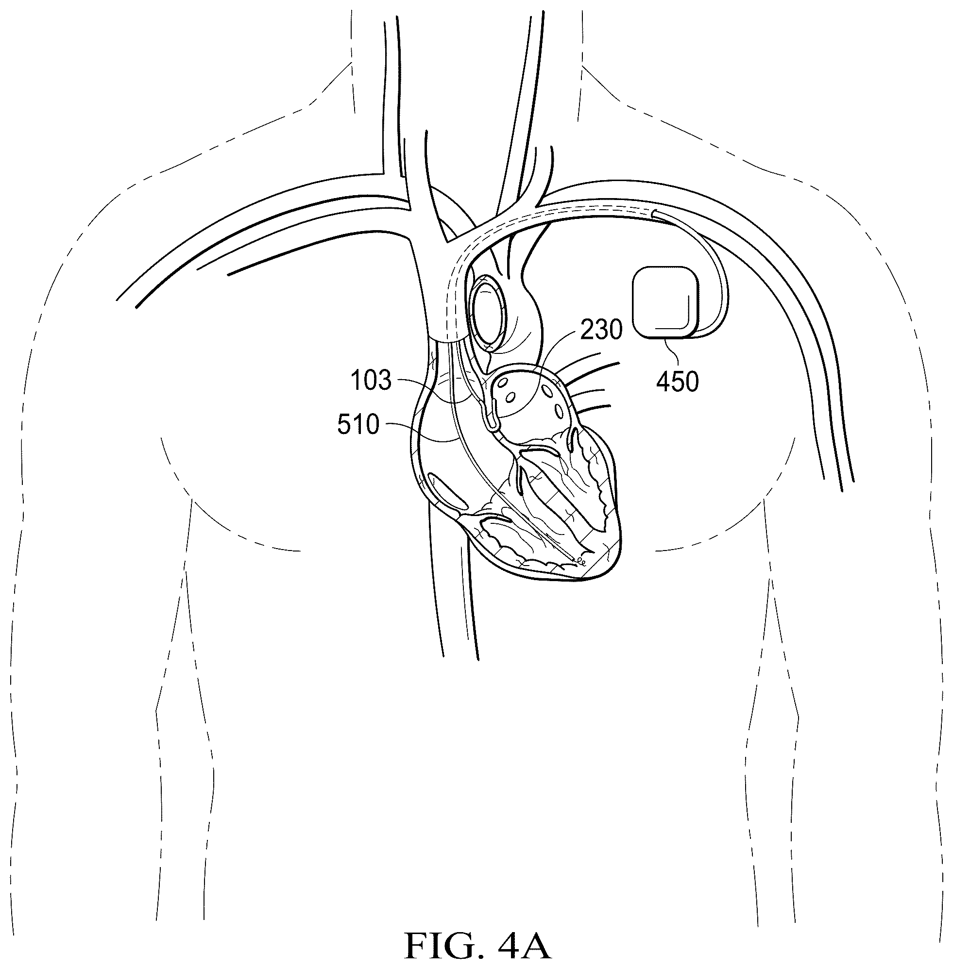 Patent US12311165 Figure 11 – Implantable endovascular, low profile intracardiac left atrial restraining devices for low energy atrial cardioversion, pacing and sensing
