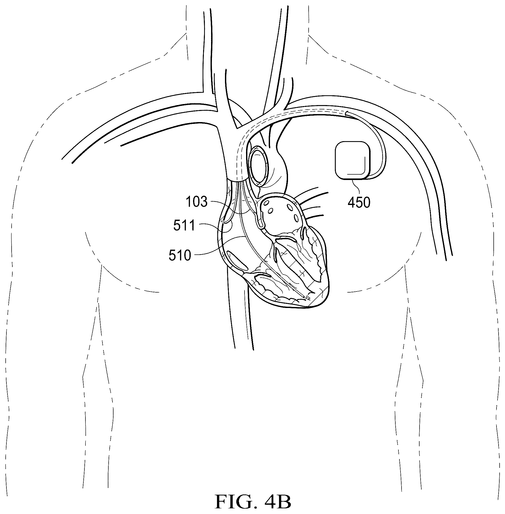 Patent US12311165 Figure 12 – Implantable endovascular, low profile intracardiac left atrial restraining devices for low energy atrial cardioversion, pacing and sensing