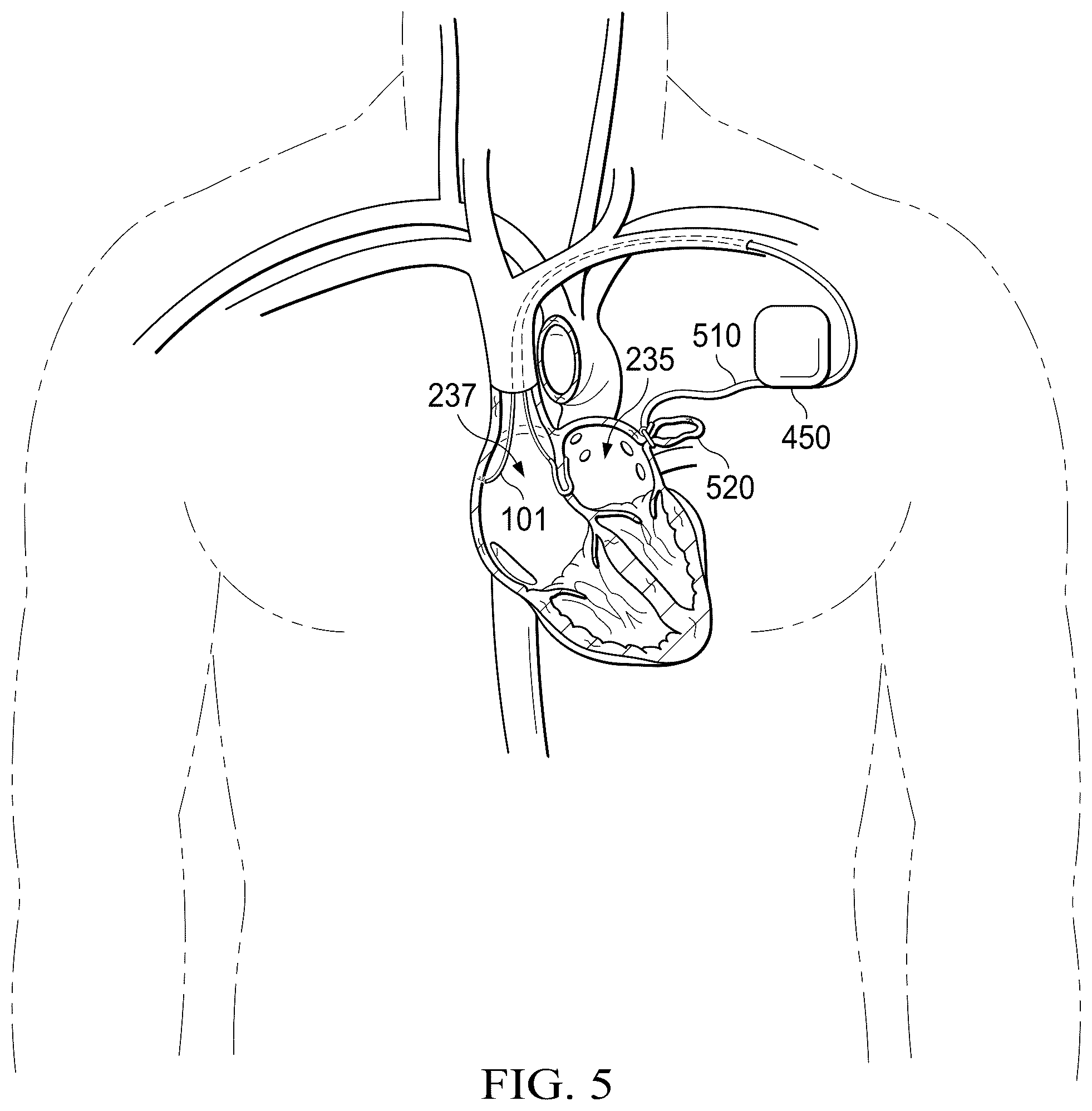 Patent US12311165 Figure 13 – Implantable endovascular, low profile intracardiac left atrial restraining devices for low energy atrial cardioversion, pacing and sensing