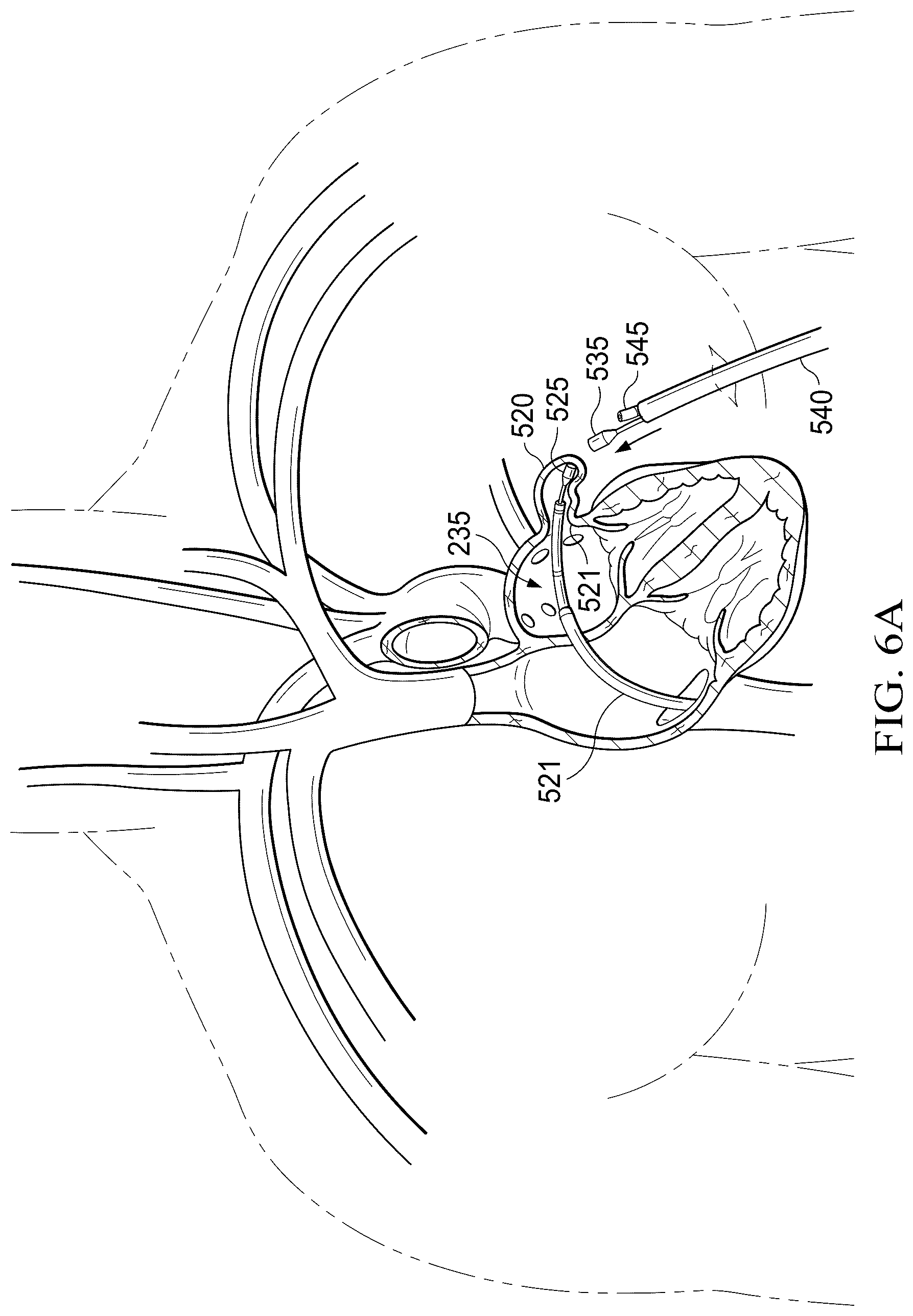 Patent US12311165 Figure 14 – Implantable endovascular, low profile intracardiac left atrial restraining devices for low energy atrial cardioversion, pacing and sensing