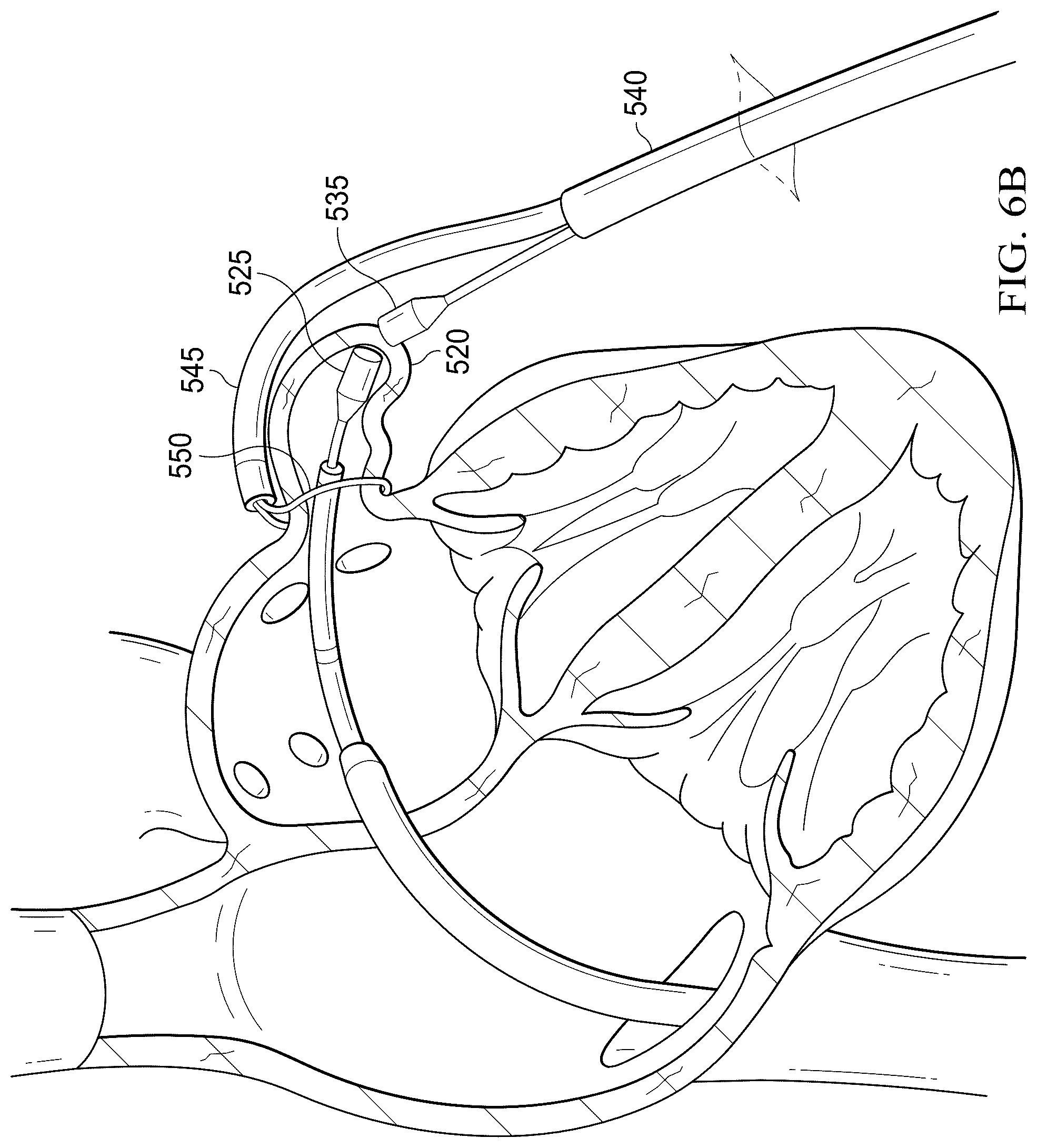 Patent US12311165 Figure 15 – Implantable endovascular, low profile intracardiac left atrial restraining devices for low energy atrial cardioversion, pacing and sensing