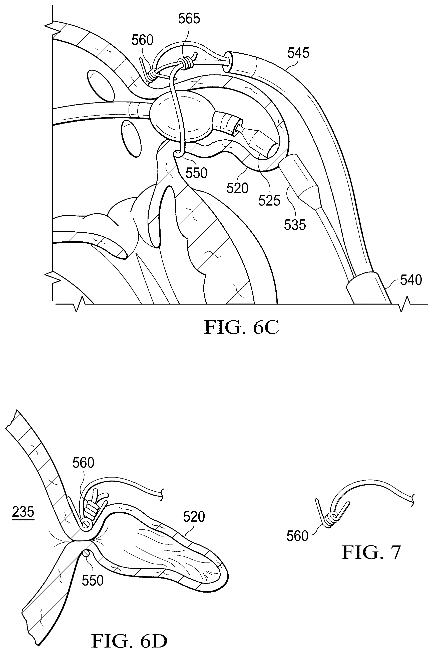 Patent US12311165 Figure 16 – Implantable endovascular, low profile intracardiac left atrial restraining devices for low energy atrial cardioversion, pacing and sensing