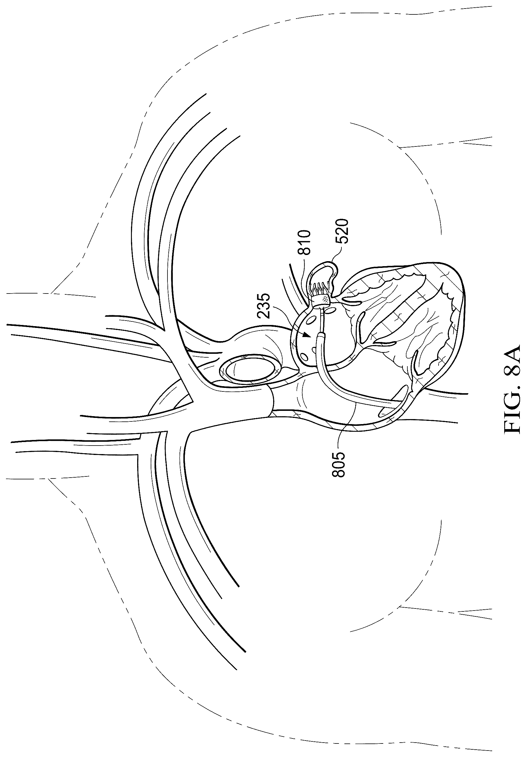 Patent US12311165 Figure 17 – Implantable endovascular, low profile intracardiac left atrial restraining devices for low energy atrial cardioversion, pacing and sensing
