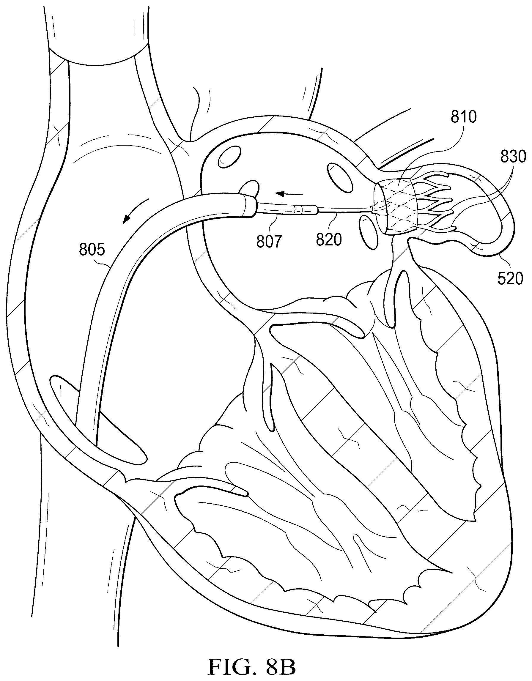 Patent US12311165 Figure 18 – Implantable endovascular, low profile intracardiac left atrial restraining devices for low energy atrial cardioversion, pacing and sensing