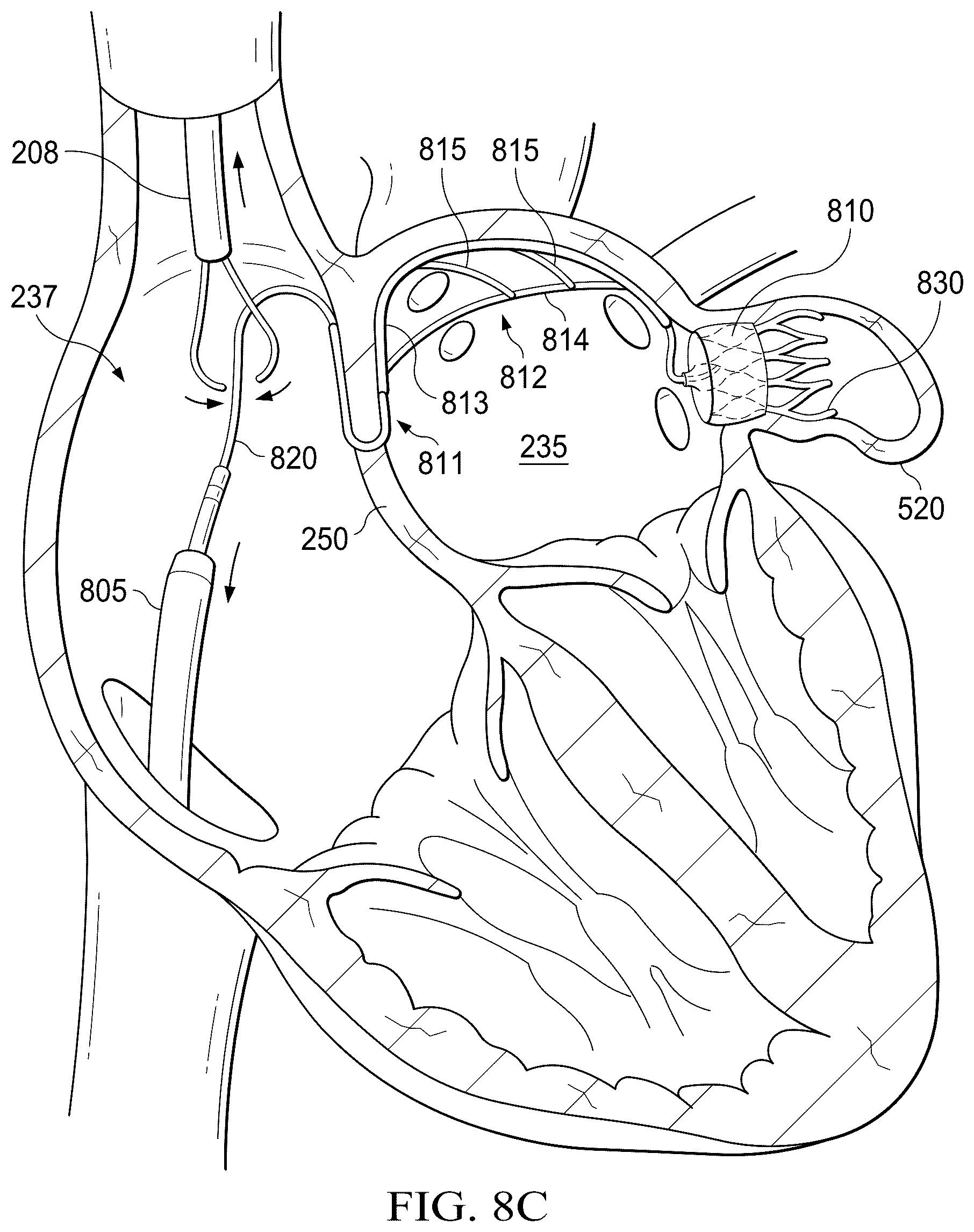 Patent US12311165 Figure 19 – Implantable endovascular, low profile intracardiac left atrial restraining devices for low energy atrial cardioversion, pacing and sensing