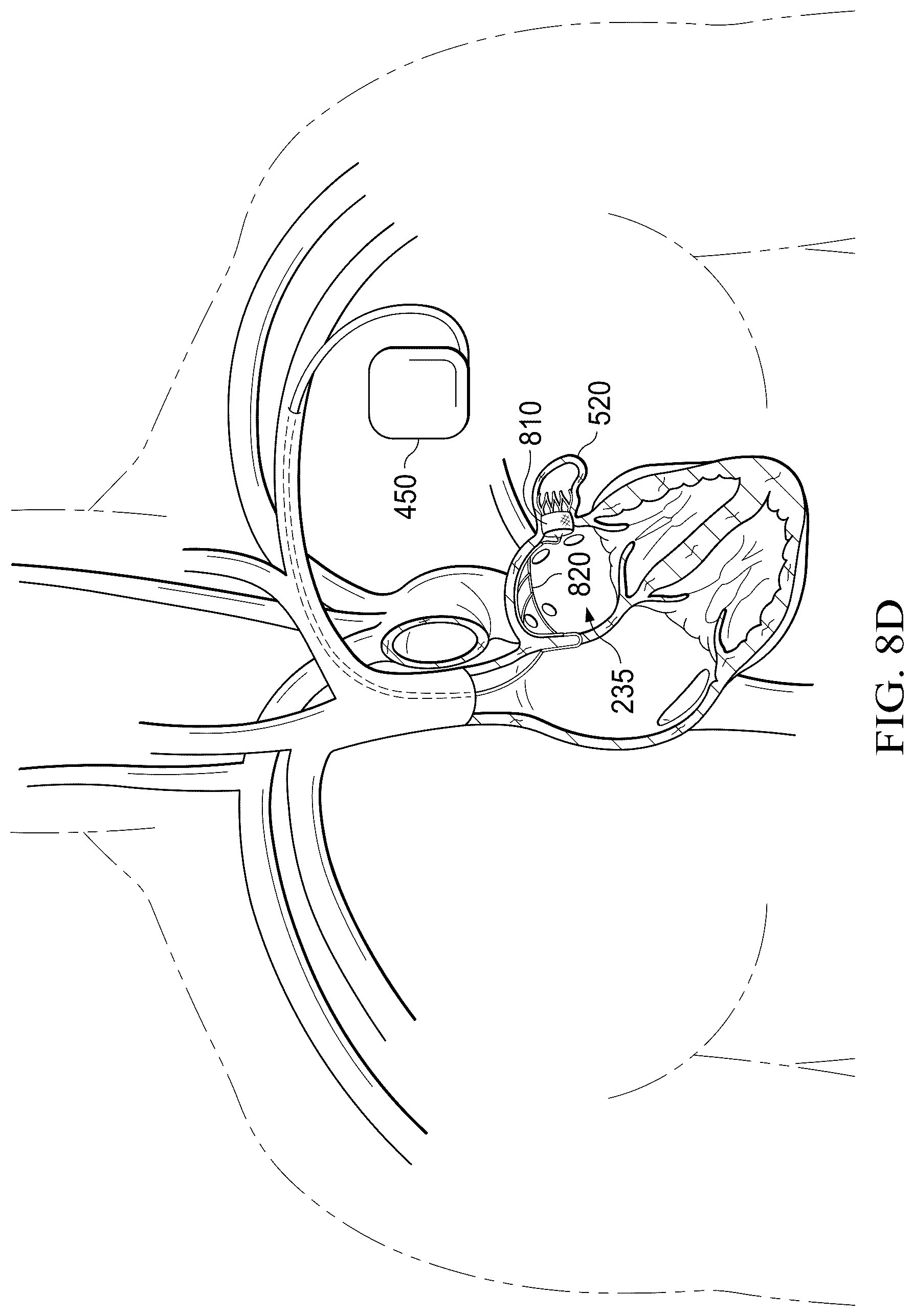 Patent US12311165 Figure 20 – Implantable endovascular, low profile intracardiac left atrial restraining devices for low energy atrial cardioversion, pacing and sensing
