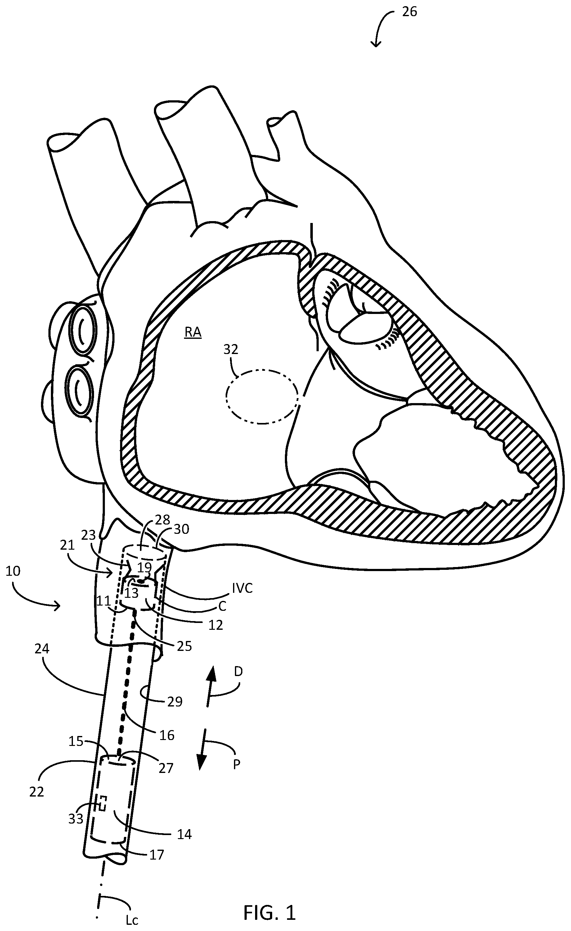 Patent US12311166 Figure 1 – Implantable medical system