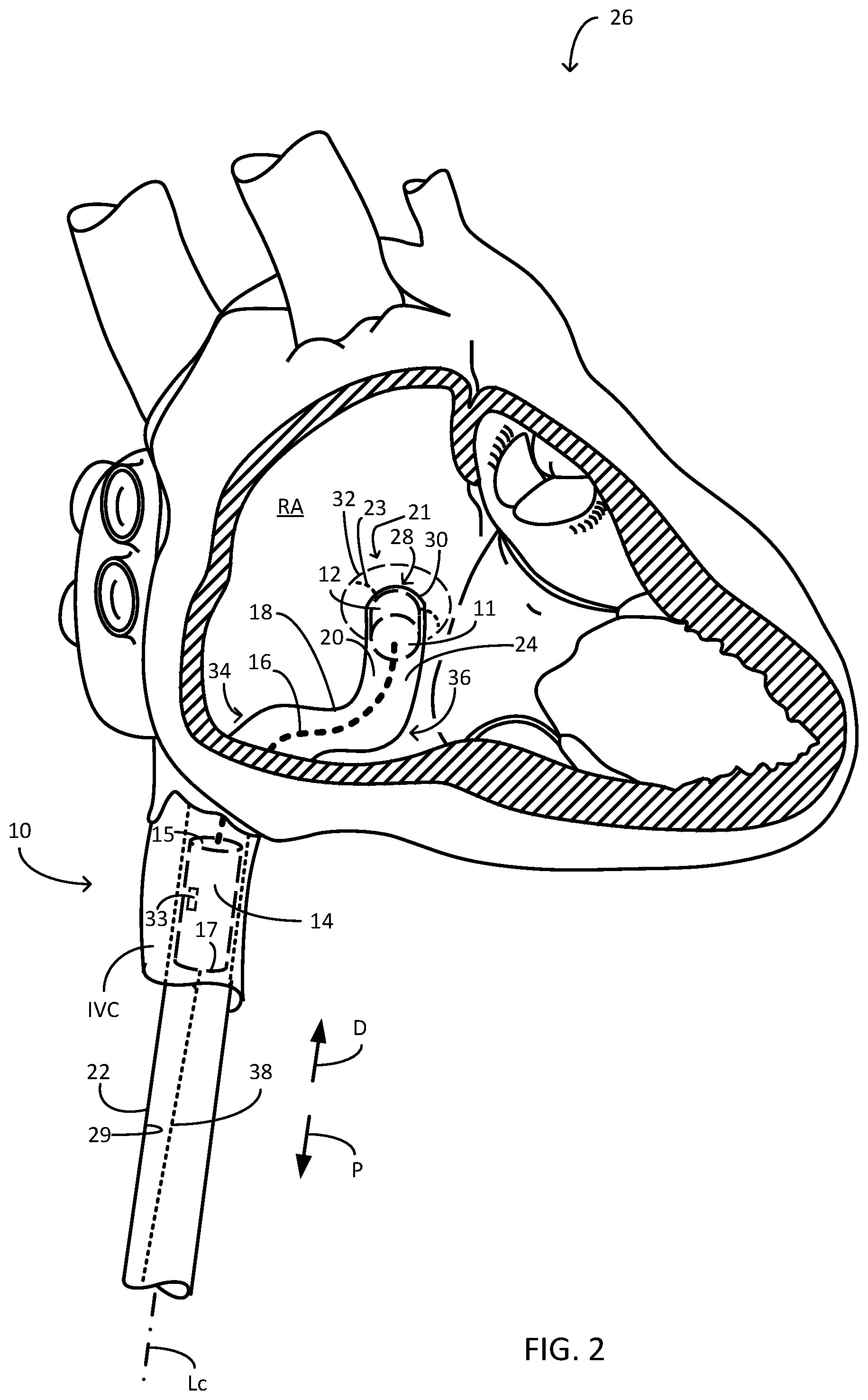 Patent US12311166 Figure 2 – Implantable medical system