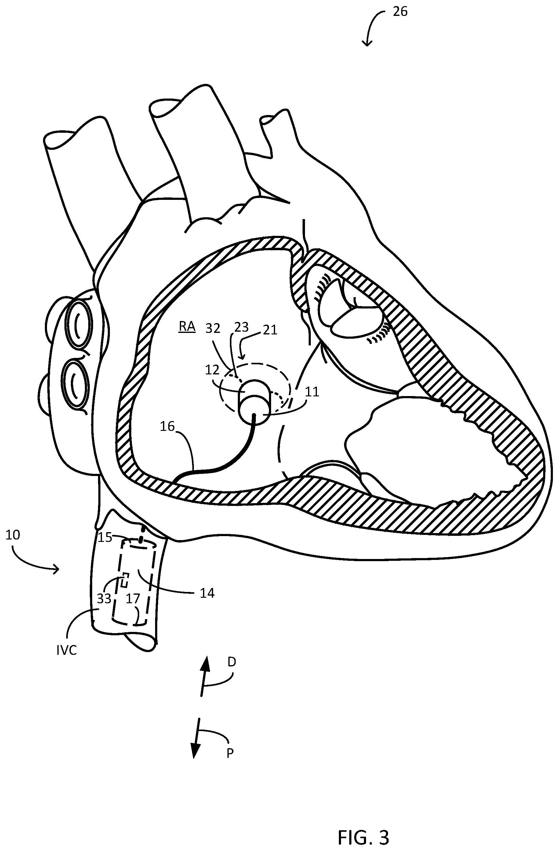 Patent US12311166 Figure 3 – Implantable medical system