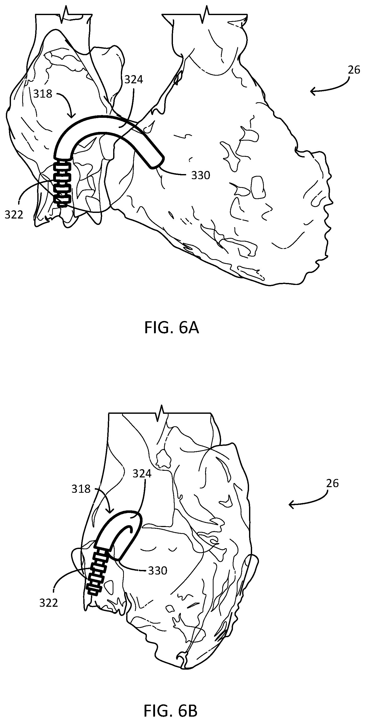 Patent US12311166 Figure 6 – Implantable medical system