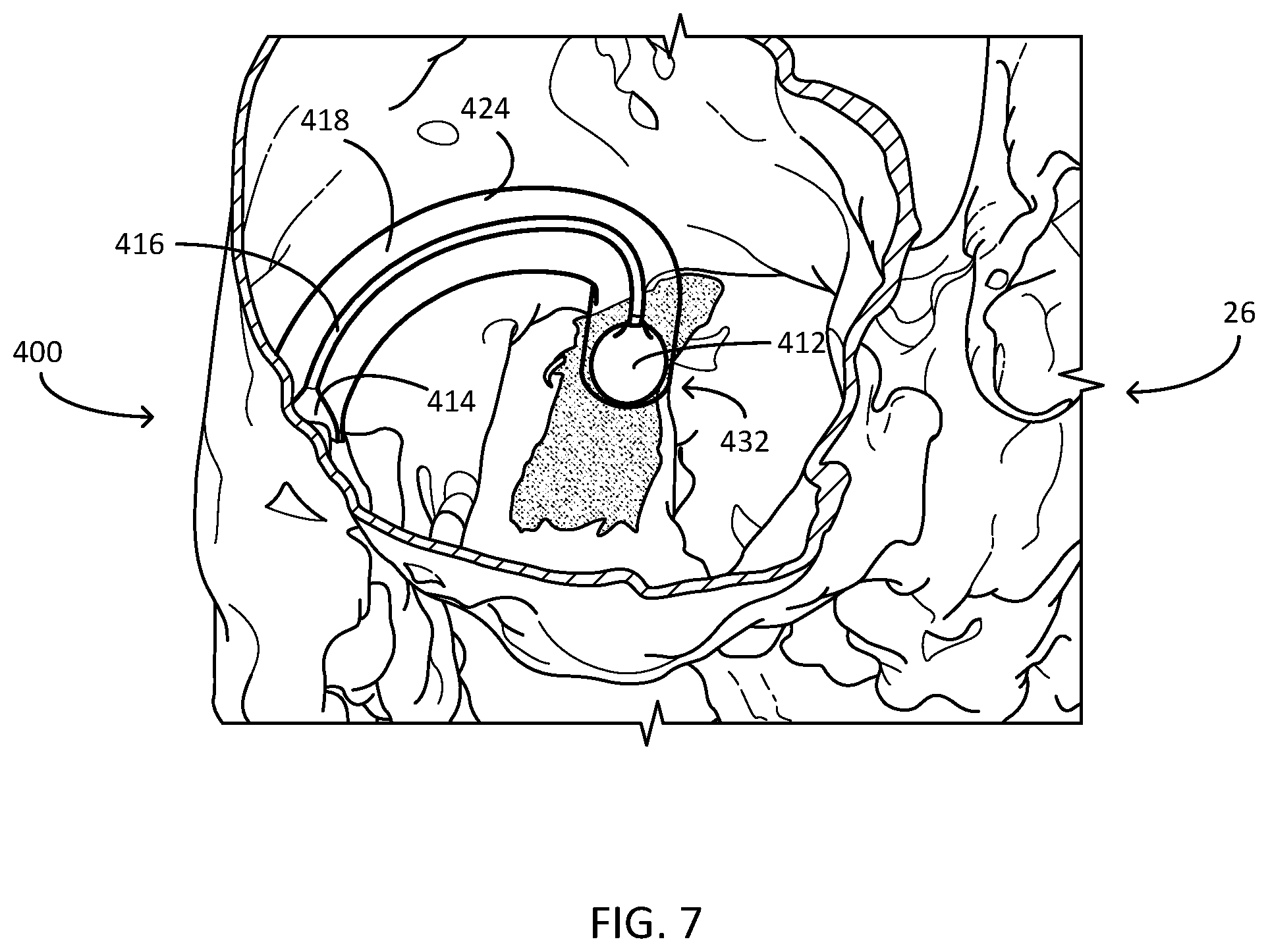 Patent US12311166 Figure 7 – Implantable medical system