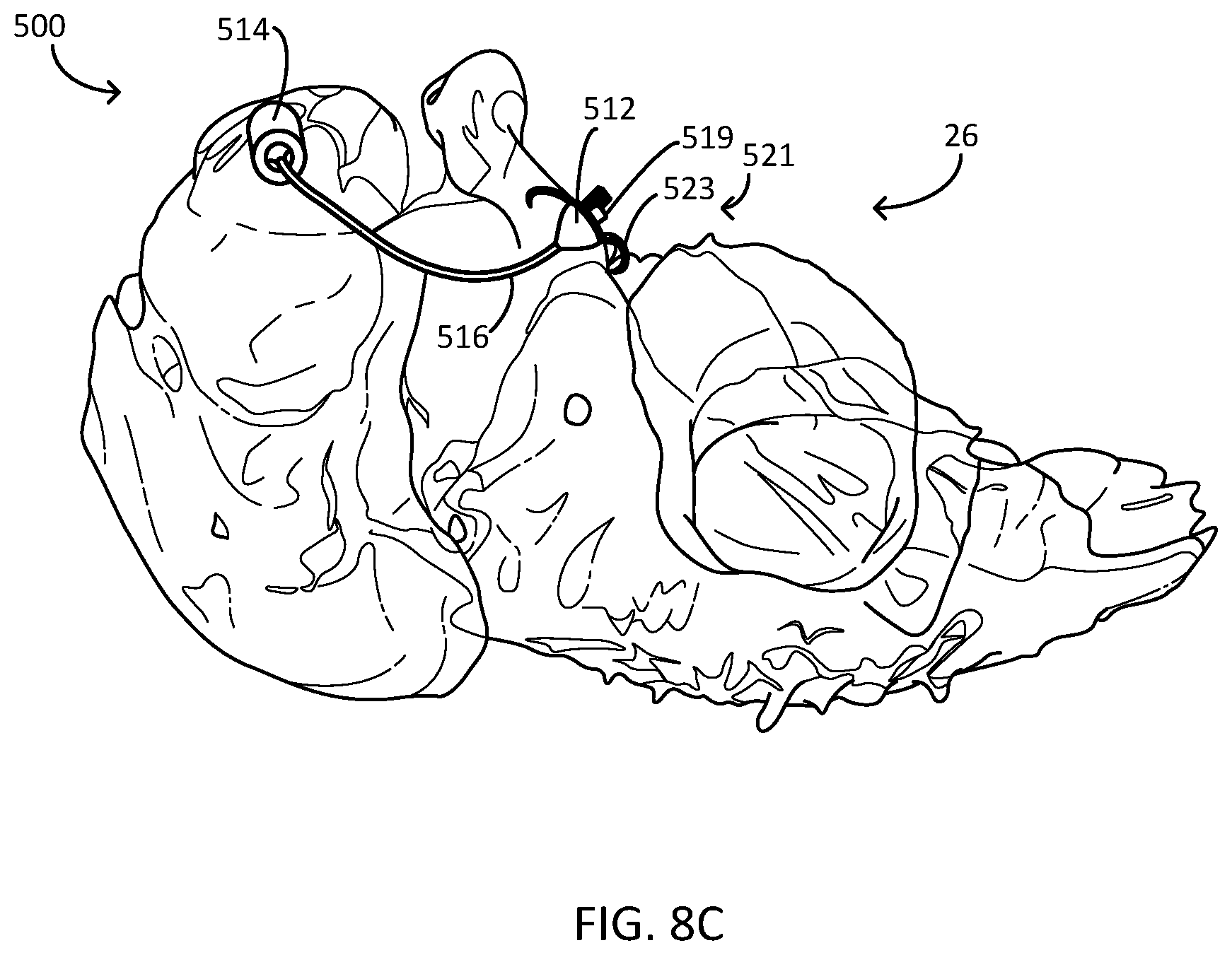 Patent US12311166 Figure 9 – Implantable medical system