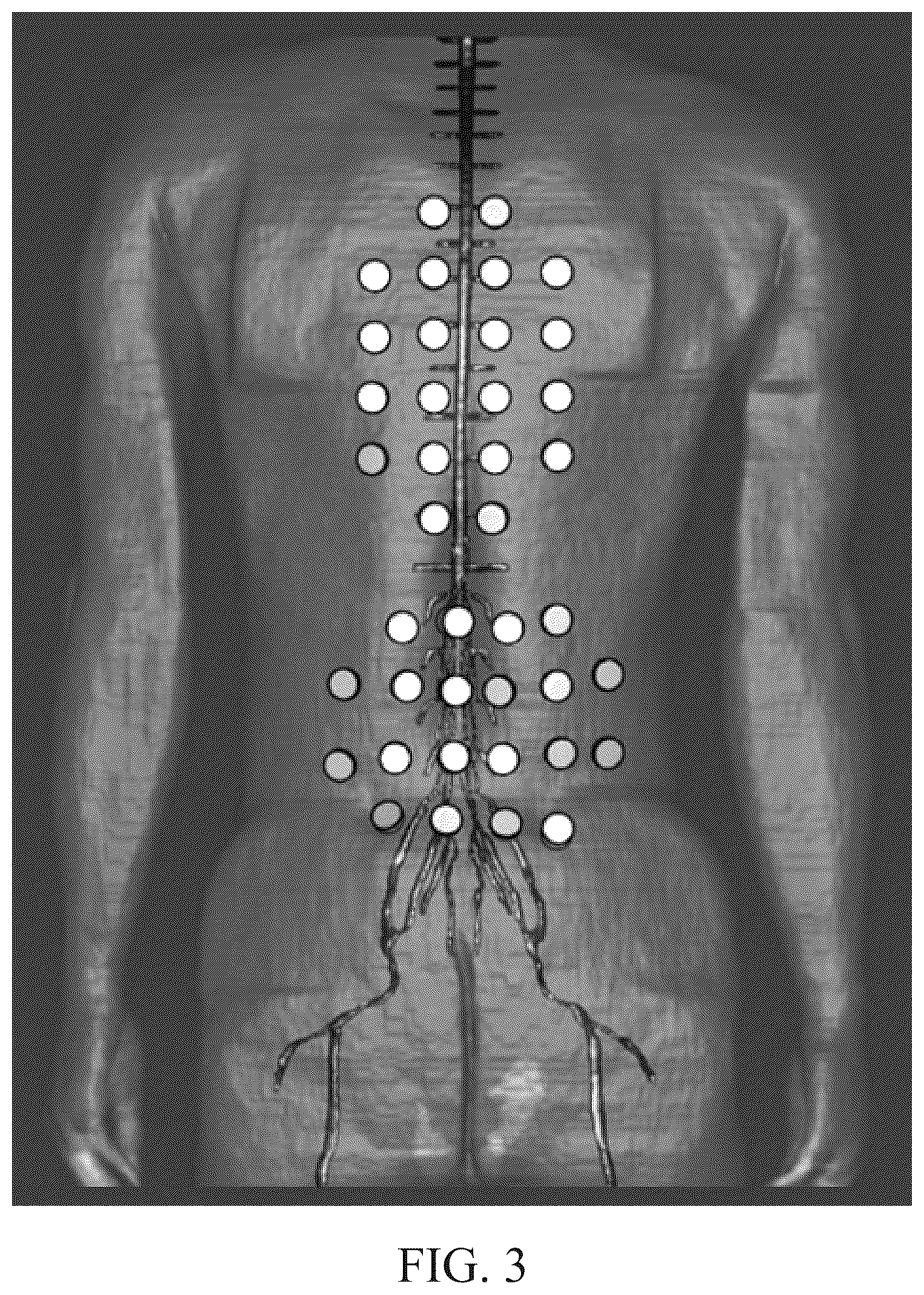 Patent US12311167 Figure 3 – Delivering alternating electric fields (e.g., TTFields) to a subject's spinal anatomy