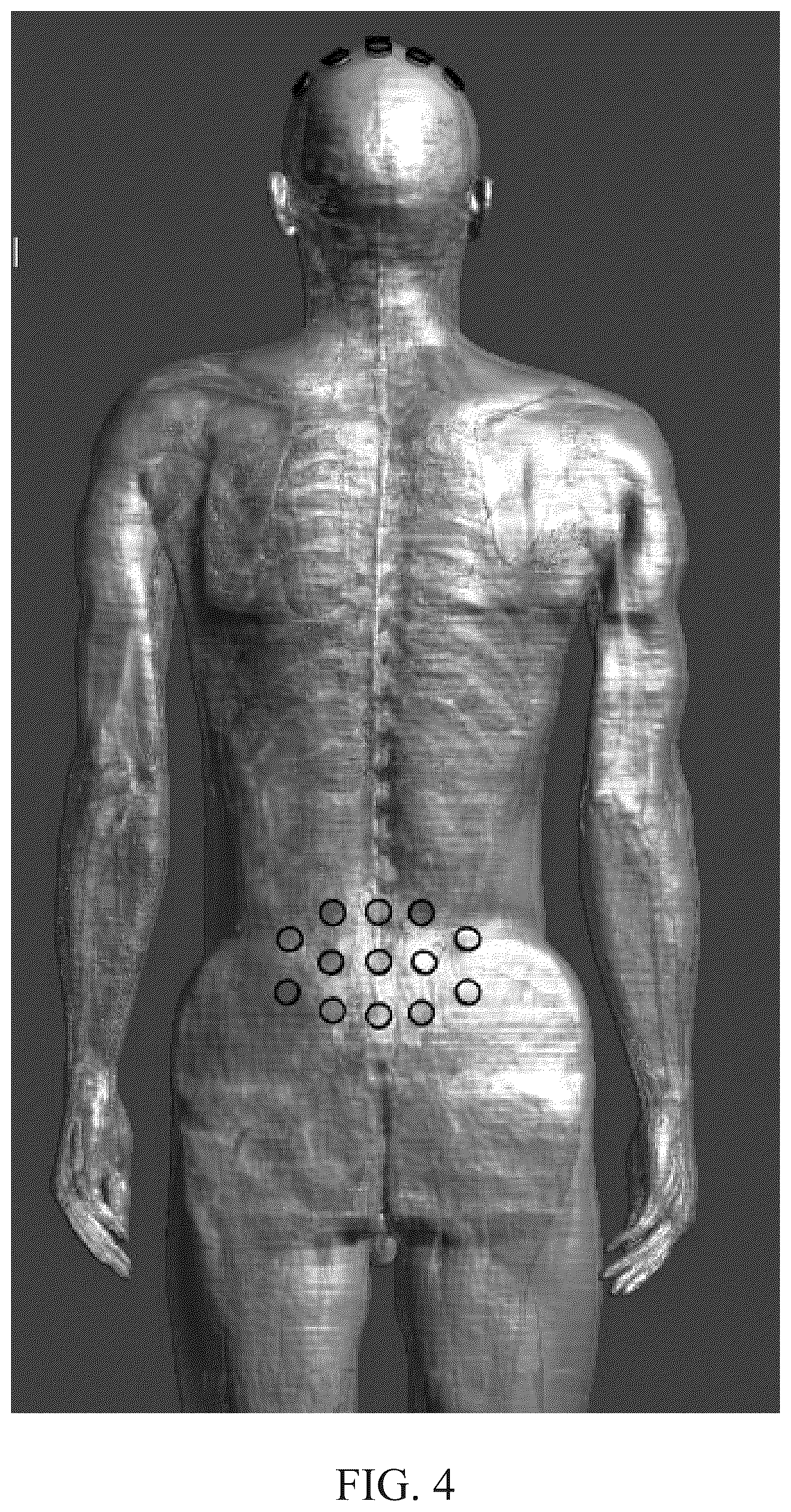Patent US12311167 Figure 4 – Delivering alternating electric fields (e.g., TTFields) to a subject's spinal anatomy
