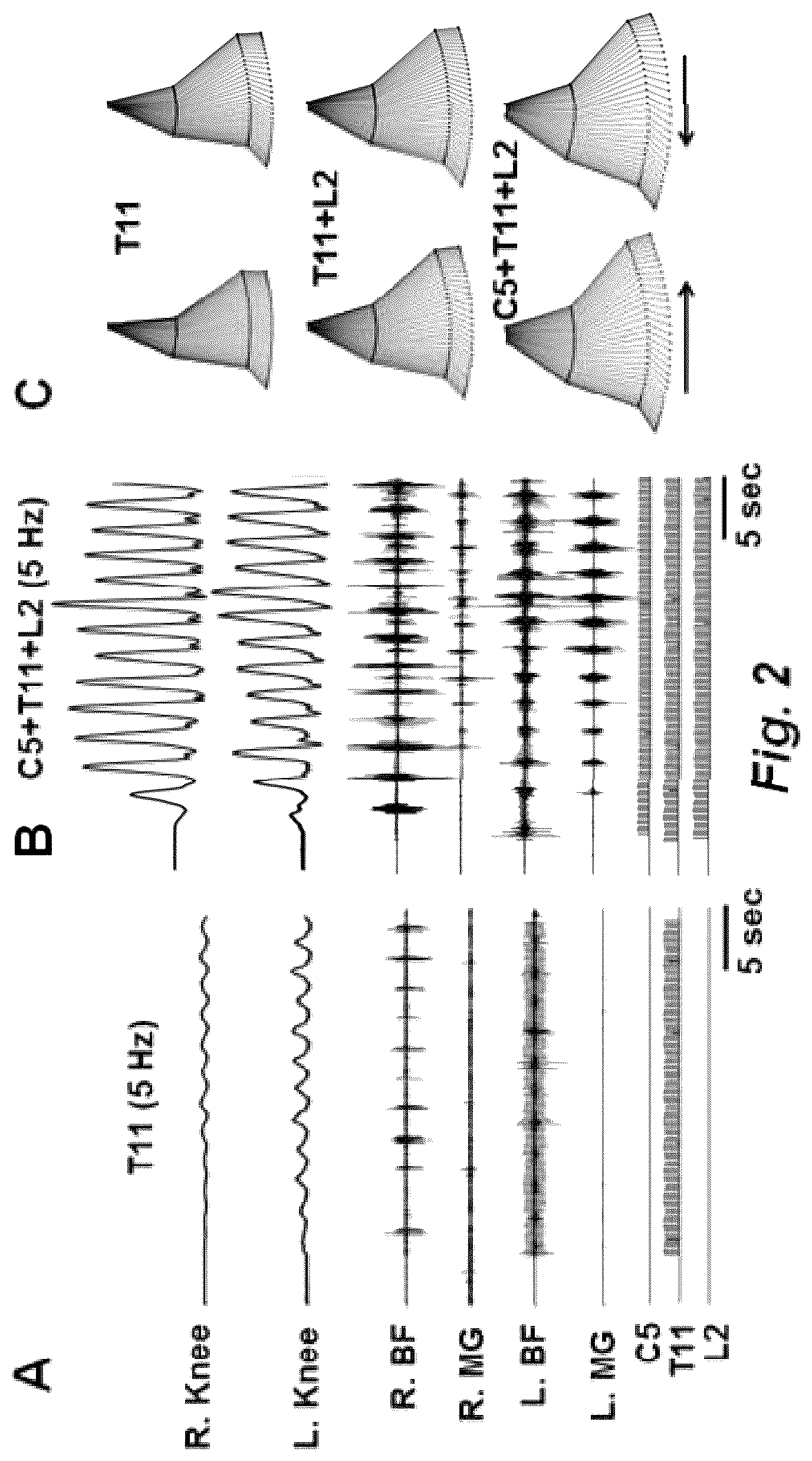 Patent US12311169 Figure 2 – Multi-site transcutaneous electrical stimulation of the spinal cord for facilitation of locomotion