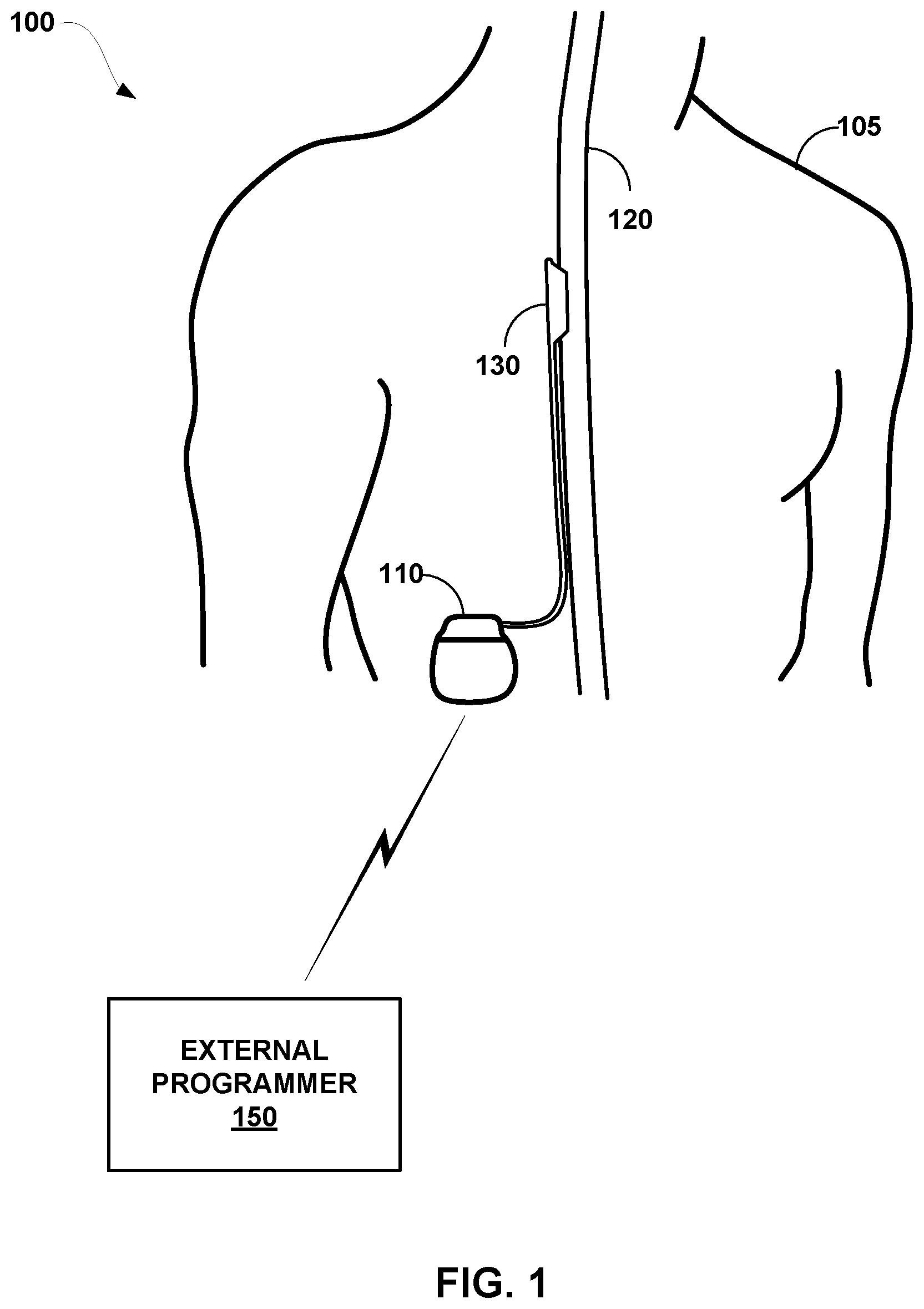 Patent US12311176 Figure 1 – Implantable lead location using ECAP