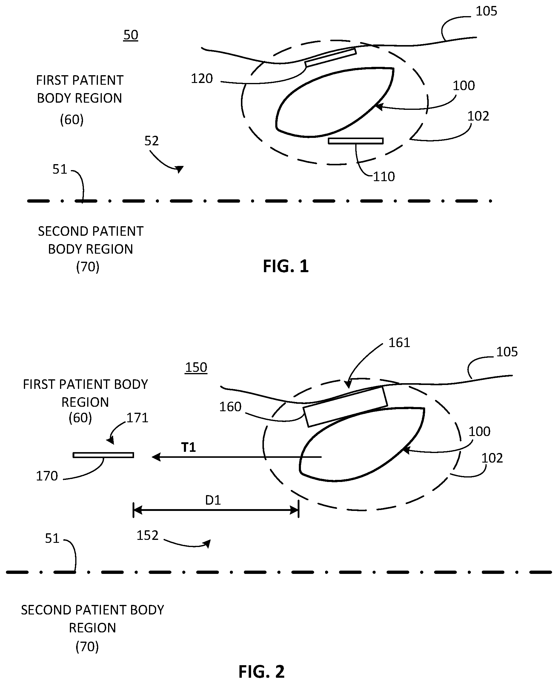 Patent US12311179 Figure 1 – Implant-access incision and sensing for sleep disordered breathing (SDB) care