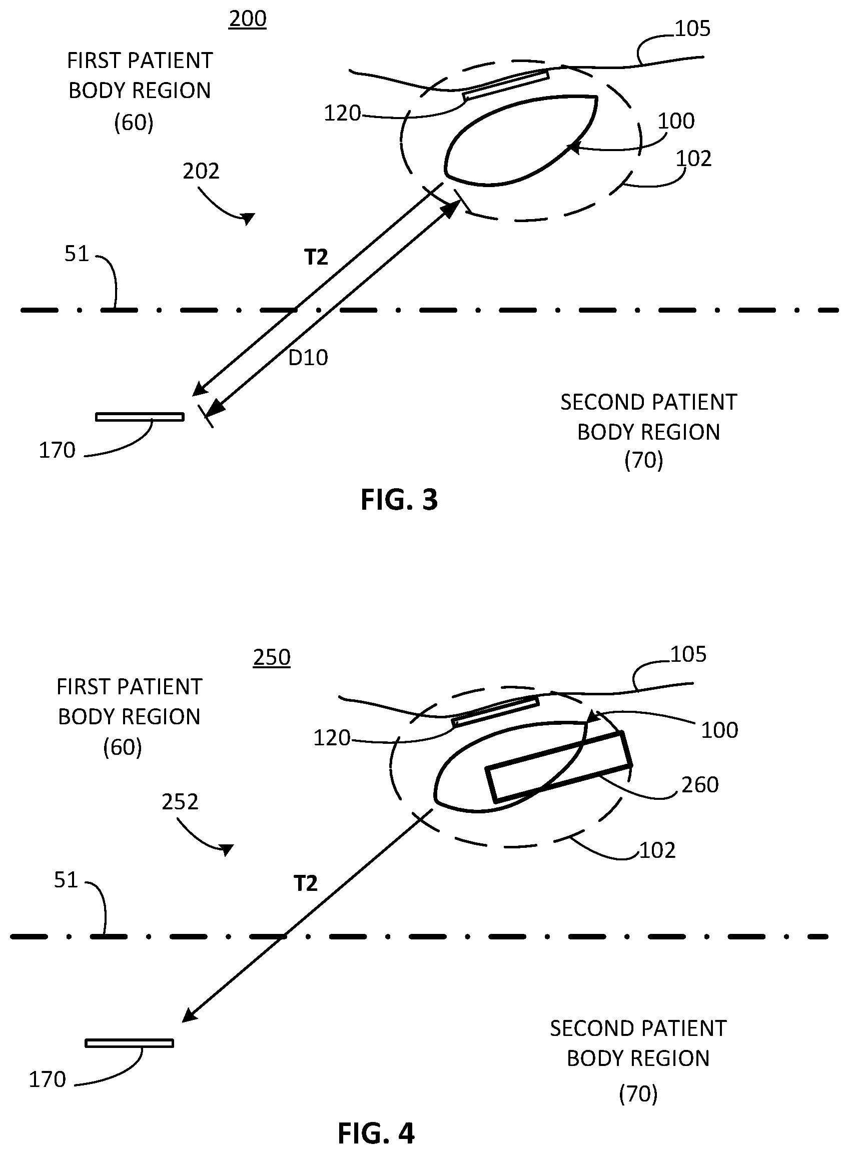 Patent US12311179 Figure 2 – Implant-access incision and sensing for sleep disordered breathing (SDB) care