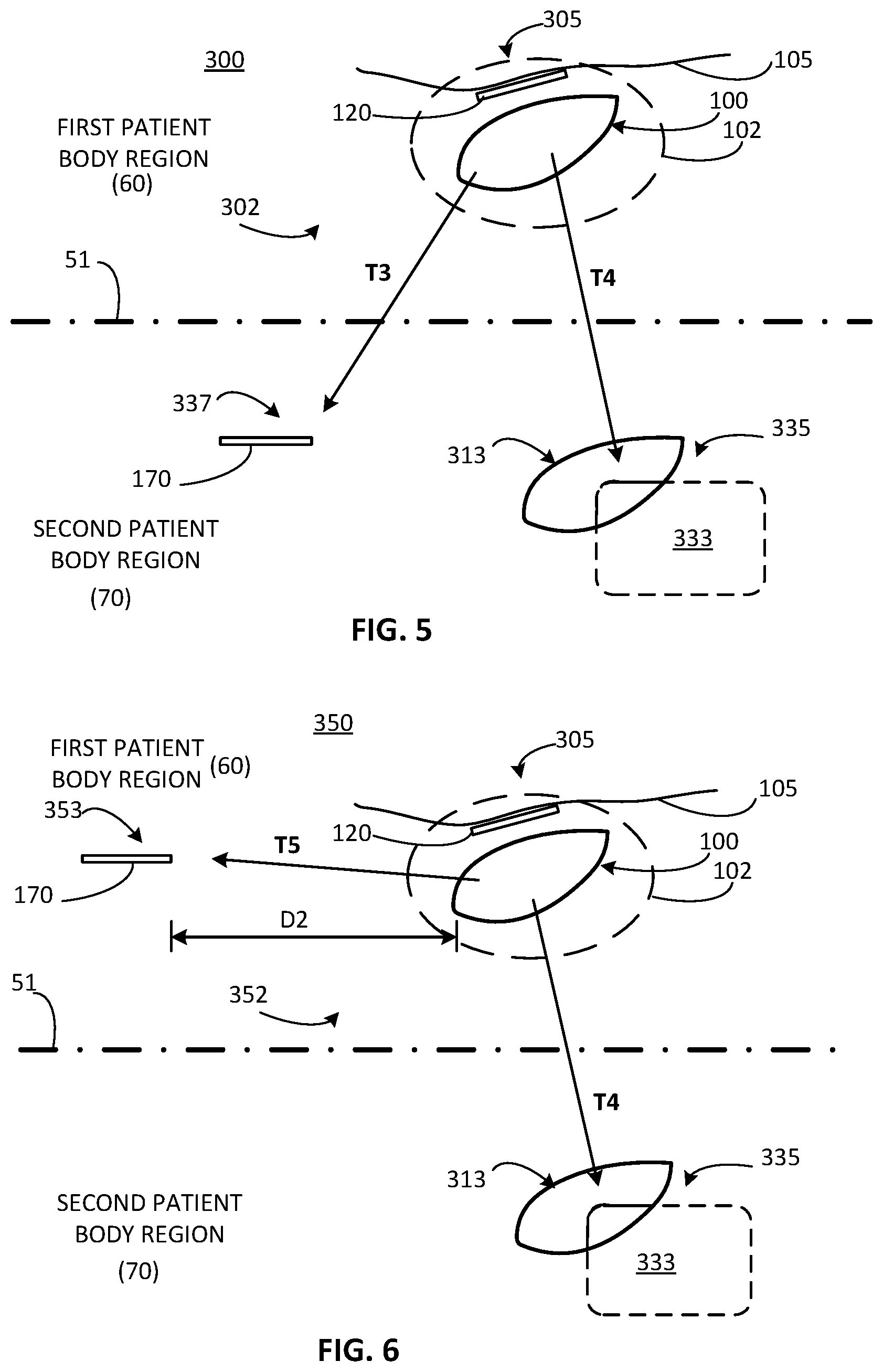 Patent US12311179 Figure 3 – Implant-access incision and sensing for sleep disordered breathing (SDB) care
