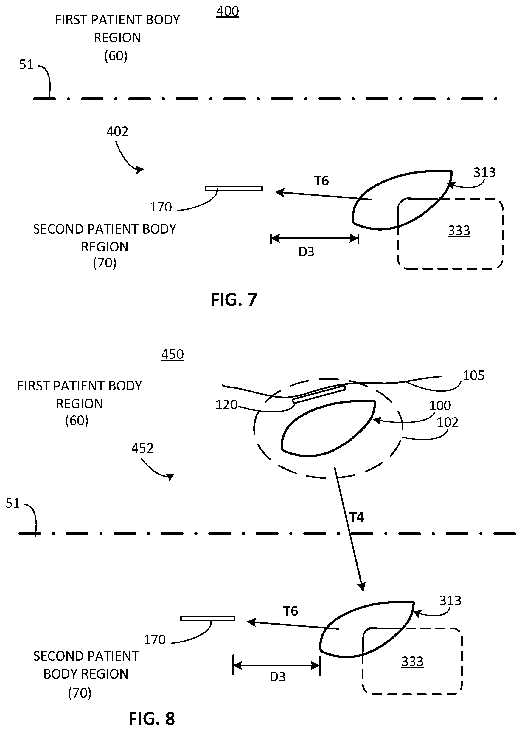 Patent US12311179 Figure 4 – Implant-access incision and sensing for sleep disordered breathing (SDB) care