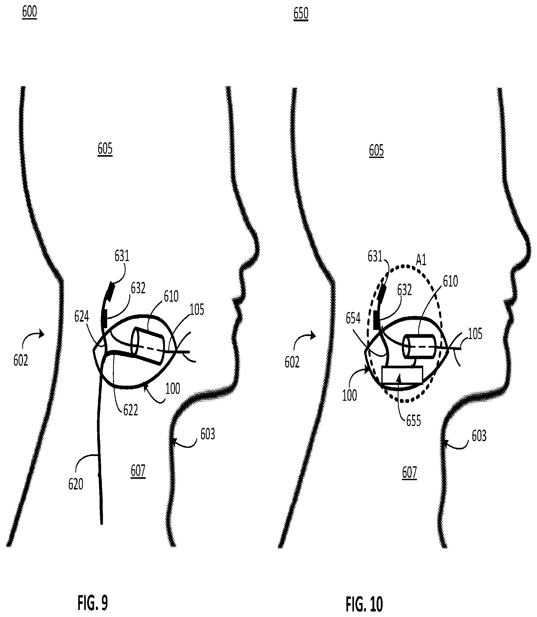 Patent US12311179 Figure 5 – Implant-access incision and sensing for sleep disordered breathing (SDB) care