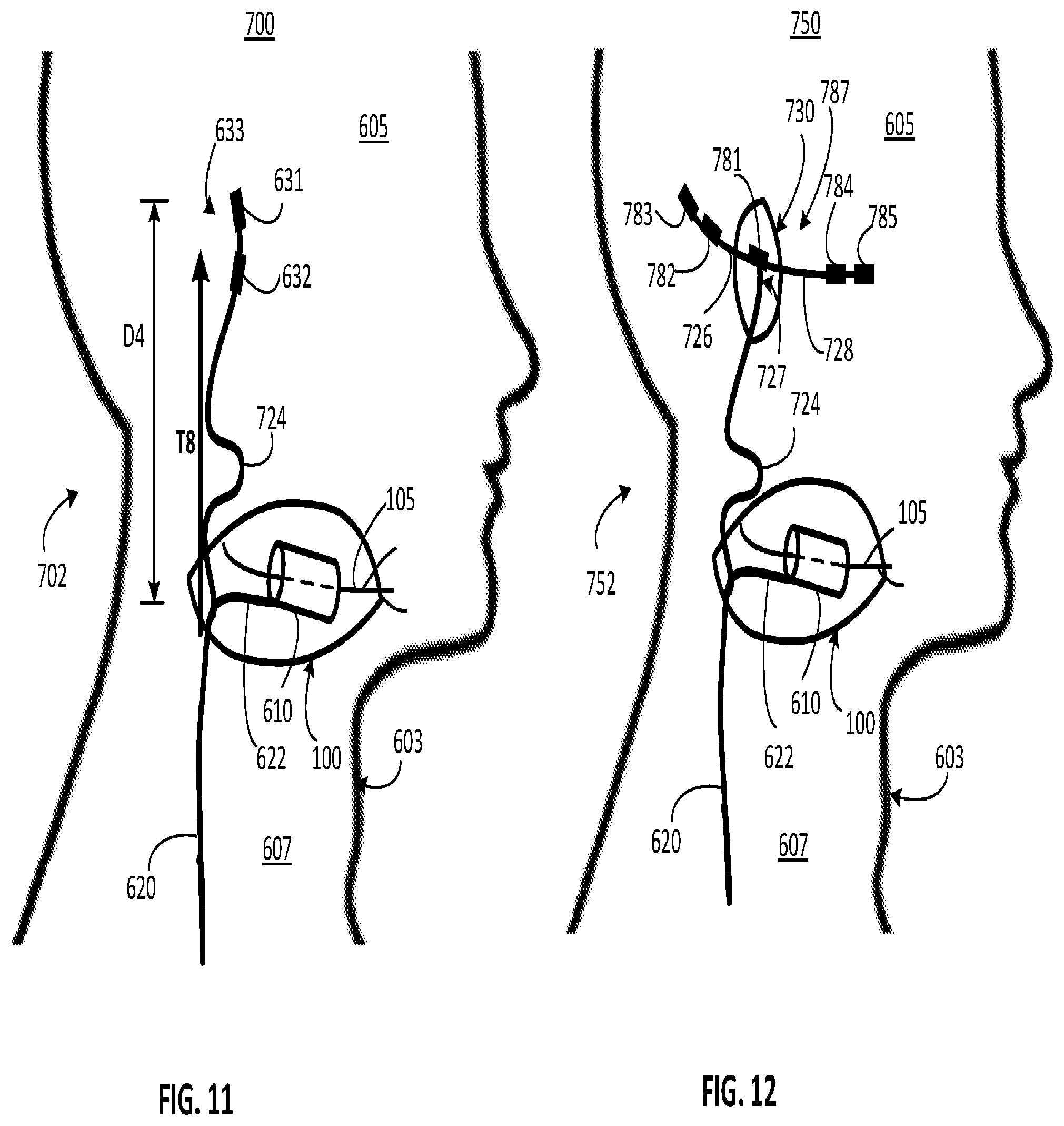 Patent US12311179 Figure 6 – Implant-access incision and sensing for sleep disordered breathing (SDB) care