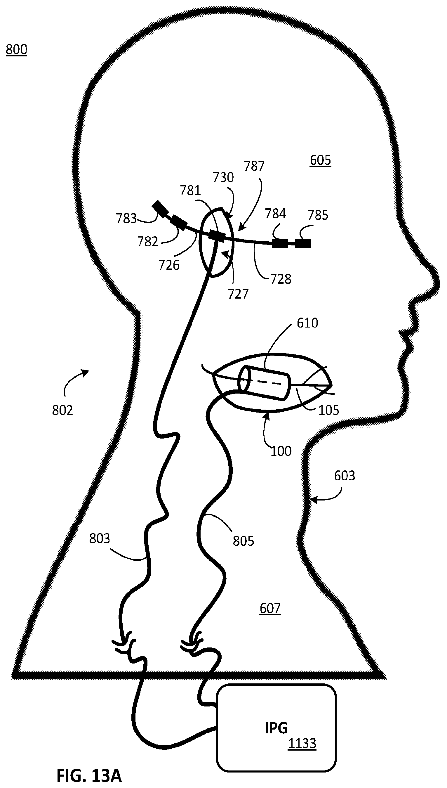 Patent US12311179 Figure 7 – Implant-access incision and sensing for sleep disordered breathing (SDB) care