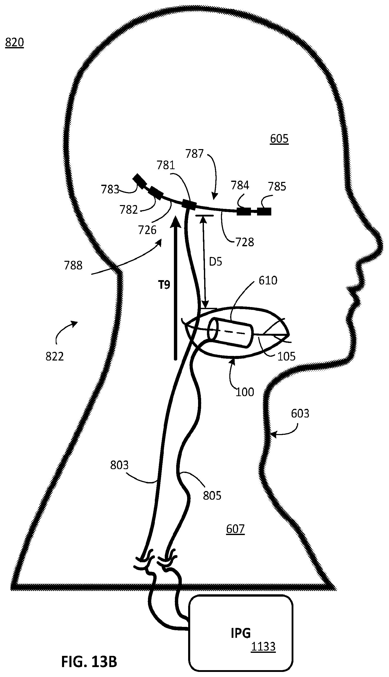 Patent US12311179 Figure 8 – Implant-access incision and sensing for sleep disordered breathing (SDB) care