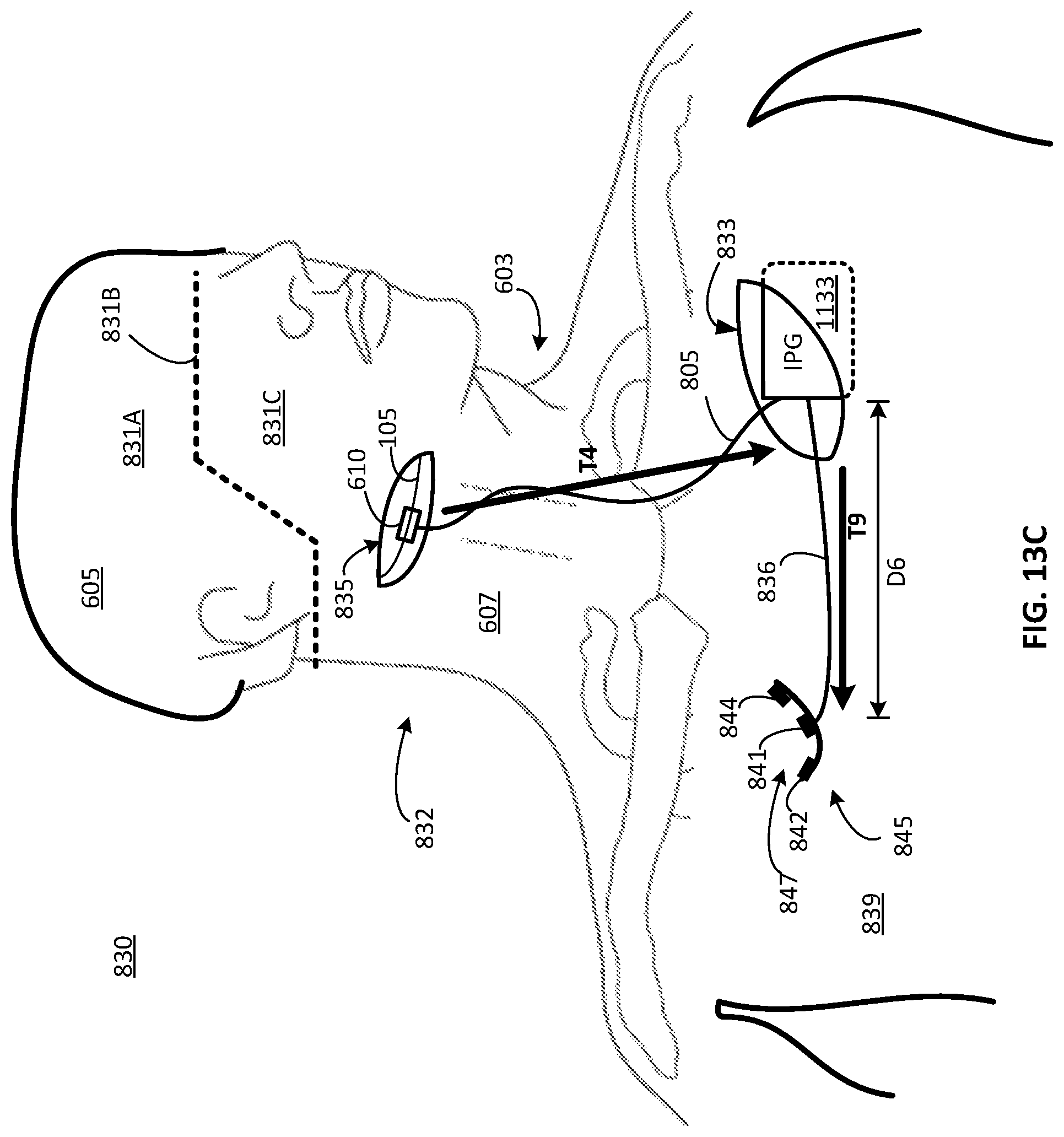 Patent US12311179 Figure 9 – Implant-access incision and sensing for sleep disordered breathing (SDB) care