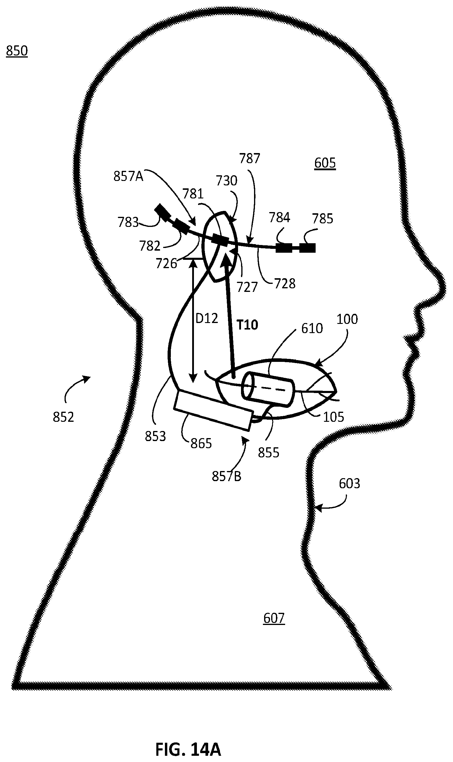 Patent US12311179 Figure 10 – Implant-access incision and sensing for sleep disordered breathing (SDB) care