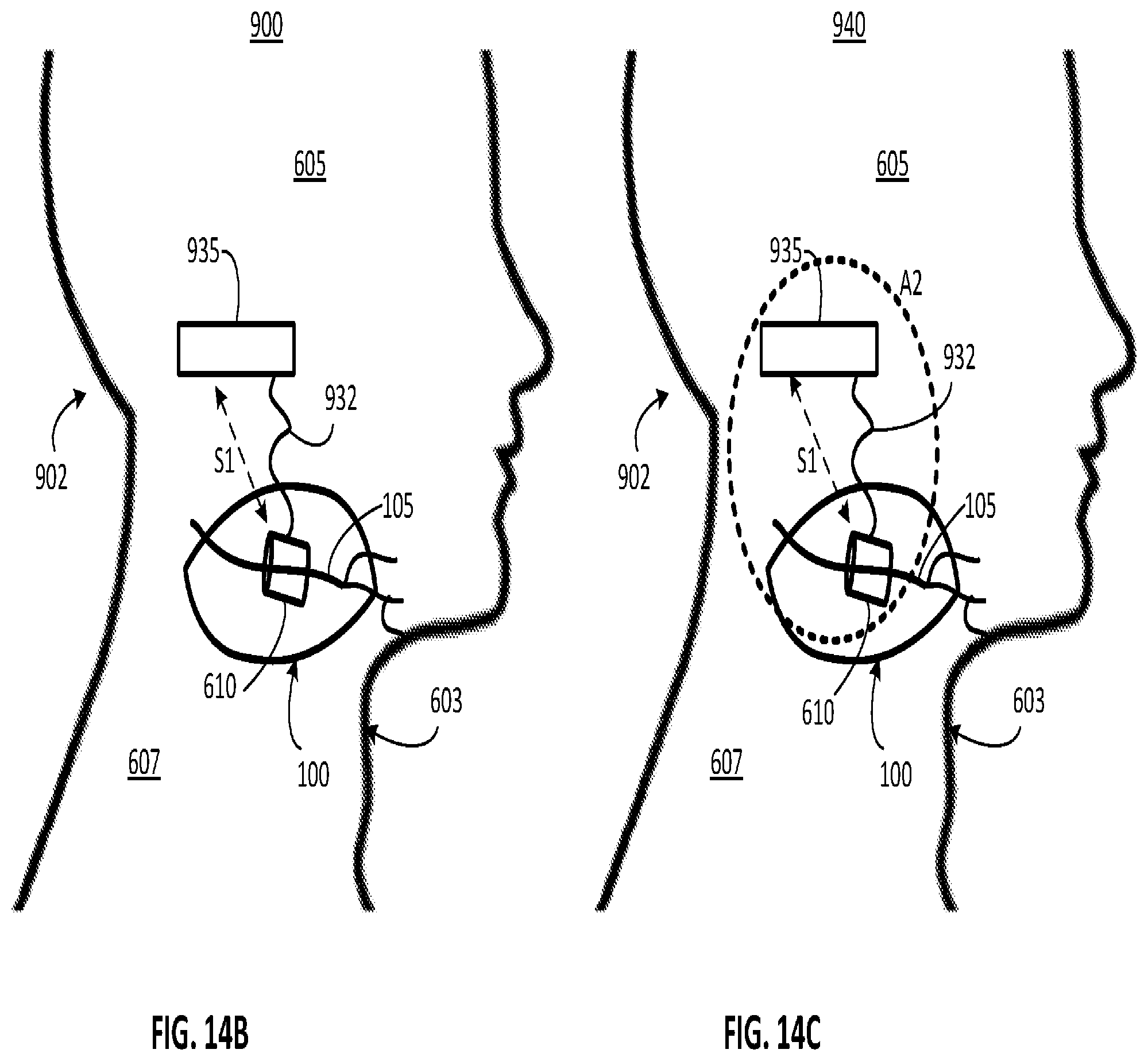 Patent US12311179 Figure 11 – Implant-access incision and sensing for sleep disordered breathing (SDB) care