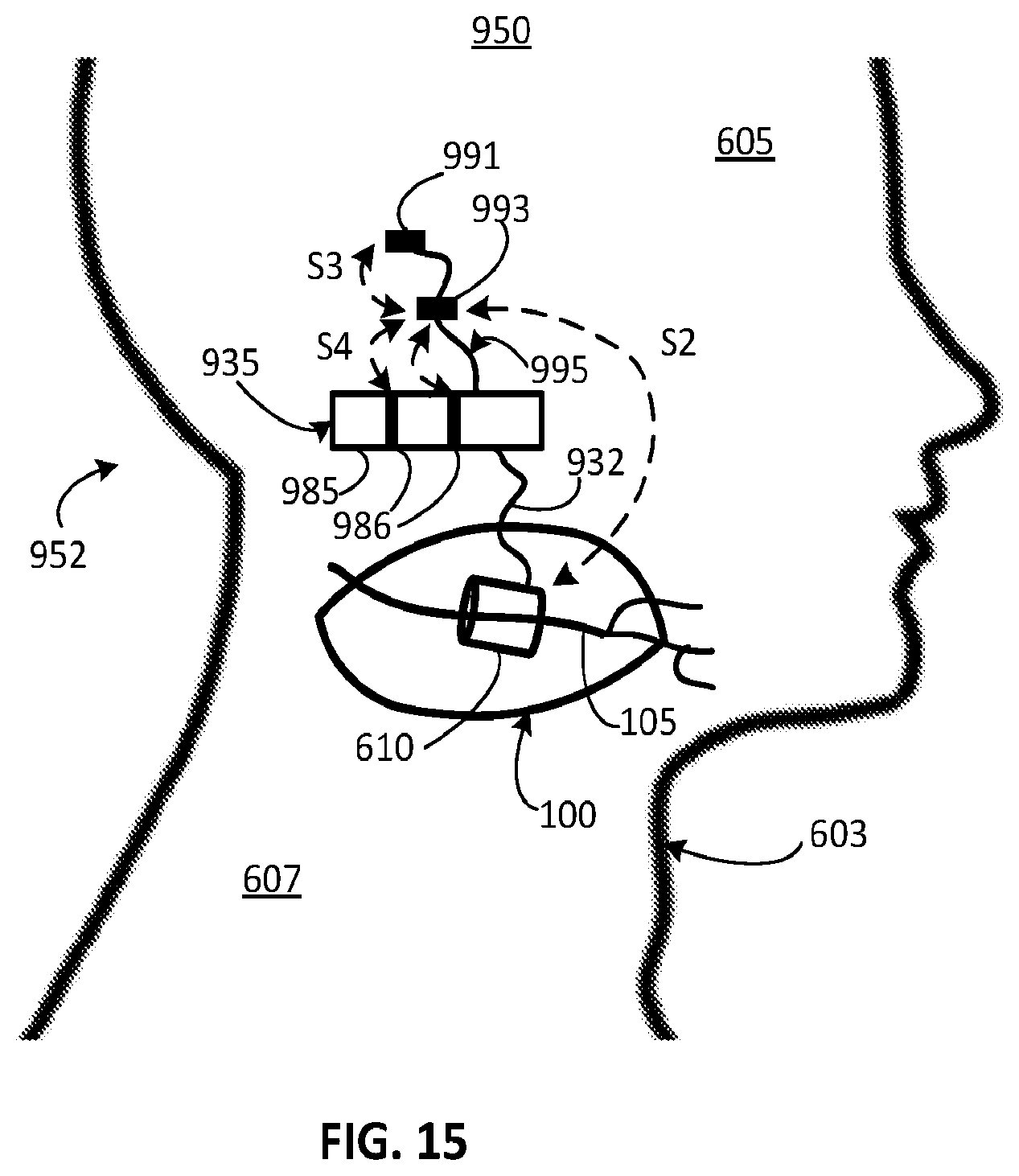 Patent US12311179 Figure 12 – Implant-access incision and sensing for sleep disordered breathing (SDB) care