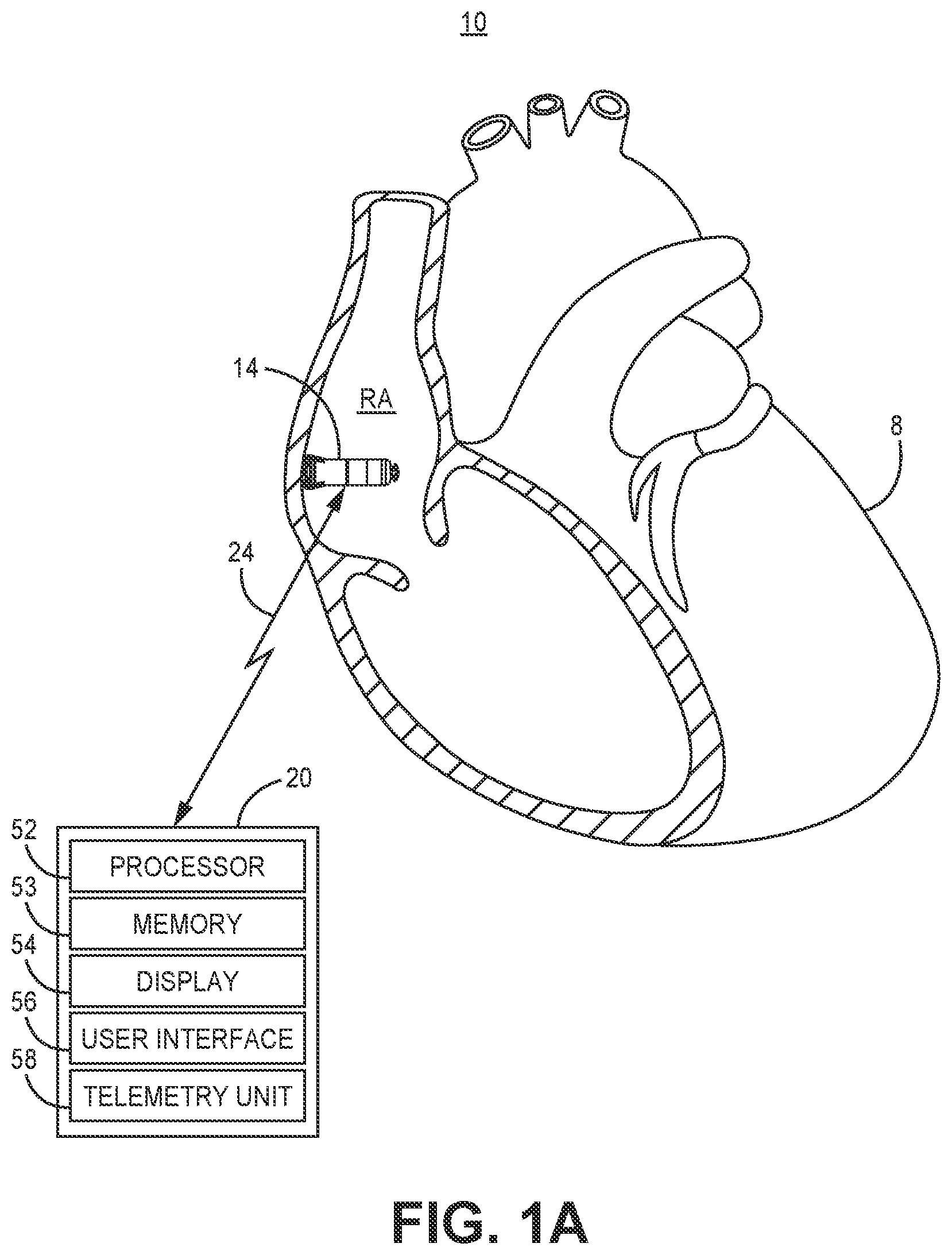 Patent US12311182 Figure 1 – Device and method for atrial tachyarrhythmia detection