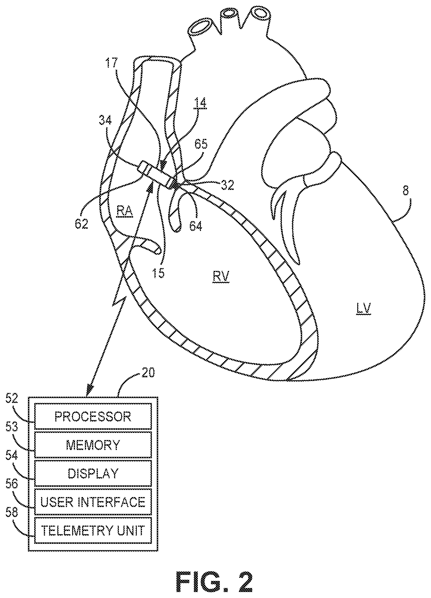 Patent US12311182 Figure 3 – Device and method for atrial tachyarrhythmia detection