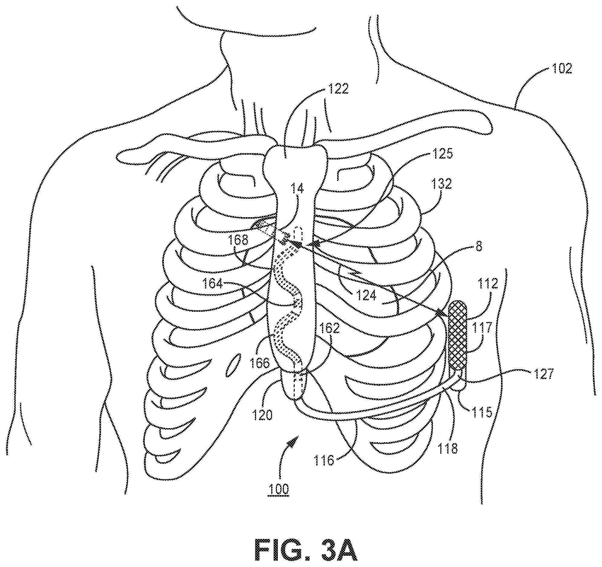 Patent US12311182 Figure 4 – Device and method for atrial tachyarrhythmia detection