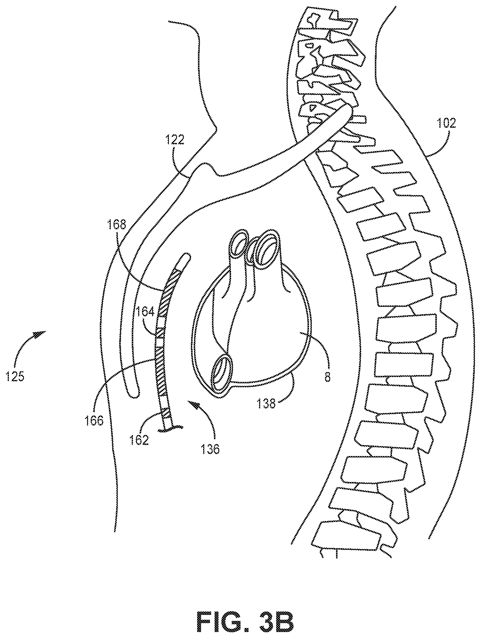 Patent US12311182 Figure 5 – Device and method for atrial tachyarrhythmia detection